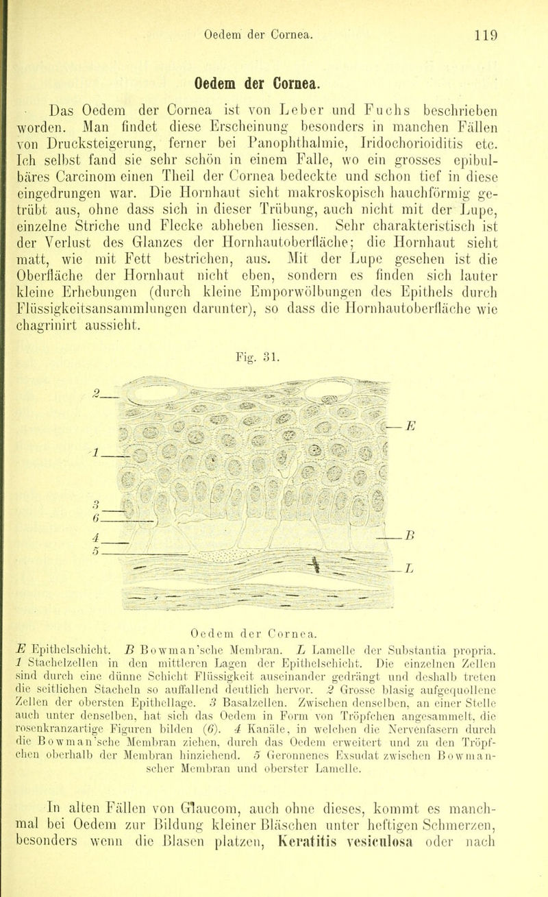 Oedem der Cornea. Das Oedem der Cornea ist von Leber und Fuchs beschrieben worden. Man findet diese Erscheinung besonders in manchen Fällen von Drucksteigerung, ferner bei Panophthalmie, Iridochorioiditis etc. Ich selbst fand sie sehr schön in einem Falle, wo ein grosses epibul- bäres Carcinom einen Theil der Cornea bedeckte und schon tief in diese eingedrungen war. Die Flornhaut sieht makroskopisch hauchförmig ge- trübt aus, ohne dass sich in dieser Trübung, auch nicht mit der Lupe, einzelne Striche und Flecke abheben Hessen. Sehr charakteristisch ist der Verlust des Glanzes der Hornhautoberfläche; die Hornhaut sieht matt, wie mit Fett bestrichen, aus. Mit der Lupe gesehen ist die Oberfläche der Hornhaut nicht eben, sondern es finden sich lauter kleine Erhebungen (durch kleine Emporwölbungen des Epithels durch Flüssigkeitsansammlungcn darunter), so dass die Hornhautoberfläche wie chagrinirt aussieht. Fig. 31. Oedem der Cornea. E Epithelscliicht. B Bowman'sclie Membran. L Lamelle der Substantia propria. 1 Stachelzellen in den mittleren Lagen der Epithelsehicht. Die einzelnen Zellen sind durch eine dünne Schicht Flüssigkeit auseinander gedrängt und deshalb treten die seitlichen Stacheln so aulfallend deutlich hervor. 2 Grosse blasig aufgequollene Zellen der obersten Epithellage. 5 Basalzellen. Zwischen denselben, an einer Stelle auch unter denselben, hat sich das Oedem in Form von Tröpfchen angesammelt, die rosenkranzartige Figuren bilden (6). 4 Kanäle, in welchen die Nervenfasern durch die Bowman'sche Membran ziehen, durch das Oedem erweitert und zu den Tröpf- chen oberhalb der Membran hinziehend. 5 Geronnenes Exsudat zwischen Bowman- scher Membran und oberster Lamelle. In alten Fällen von Glaucom, auch ohne dieses, kommt es manch- mal bei Oedem zur Bildung kleiner Bläschen unter heftigen Schmerzen, besonders wenn die Blasen platzen, Keratitis vesiciilosa oder nach