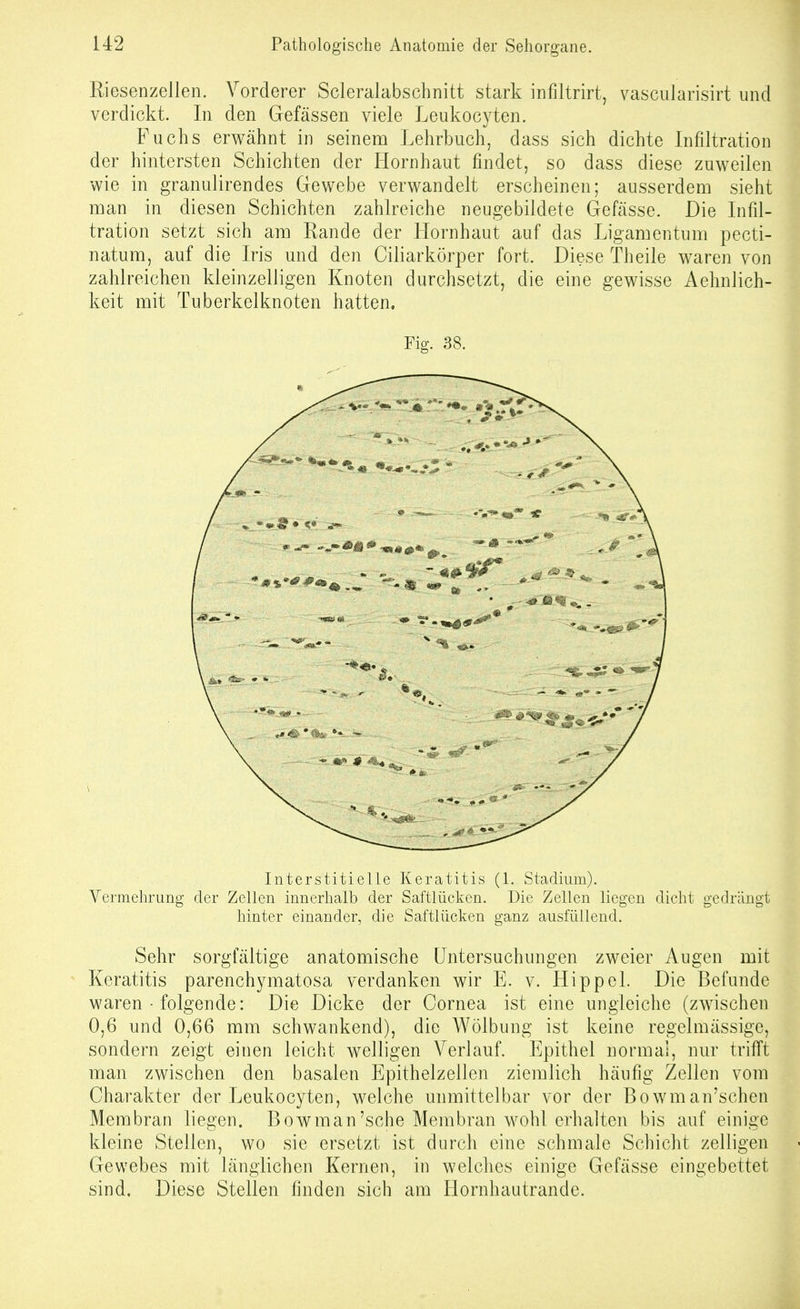 Riesenzellen. Vorderer Scleralabschnitt stark infiltrirt, vascularisirt und verdickt. In den Gefässen viele Leukocyten. Fuchs erwähnt in seinem Lehrbuch, dass sich dichte Infiltration der hintersten Schichten der Hornhaut findet, so dass diese zuweilen wie in granulirendes Gewebe verwandelt erscheinen; ausserdem sieht man in diesen Schichten zahlreiche neugebildete Gefässe. Die Infil- tration setzt sich am Rande der Hornhaut auf das Ligamentum pecti- natum, auf die Iris und den Ciliarkörper fort. Diese Theile waren von zahlreichen kleinzelligen Knoten durchsetzt, die eine gewisse Aehnlich- keit mit Tuberkelknoten hatten. Fig. 38. Interstitielle Keratitis (1. Stadium). Vermehrung der Zellen innerhalb der Saftlücken. Die Zellen liegen dicht gedrängt hinter einander, die Saftlücken ganz ausfüllend. Sehr sorgfältige anatomische Untersuchungen zweier Augen mit Keratitis parenchymatosa verdanken wir E. v. Hippel. Die Befunde waren • folgende: Die Dicke der Cornea ist eine ungleiche (zwischen 0,6 und 0,66 mm schwankend), die AVölbung ist keine regelmässige, sondern zeigt einen leicht welligen Verlauf. Epithel normal, nur trifft man zwischen den basalen Epithelzellen ziemlich häufig Zellen vom Charakter der Leukocyten, welche unmittelbar vor der Bowman'schen Membran liegen. Bowman'sche Membran wohl erhalten bis auf einige kleine Stellen, wo sie ersetzt ist durch eine schmale Schicht zelligen Gewebes mit länglichen Kernen, in welches einige Gefässe eingebettet sind. Diese Stellen finden sich am Hornhautrande.