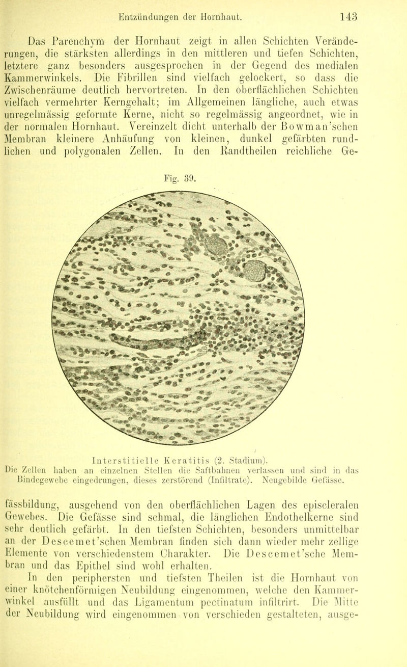 Das Pareiichyra der Hornhaut zeigt in allen Schichten Verände- rungen, die stärksten allerdings in den mittleren und tiefen Schichten, letztere ganz besonders ausgesprochen in der Gegend des medialen Kammerwinkels. Die Fibrillen sind vielfach gelockert, so dass die Zwischenräume deutlich hervortreten. In den oberflächlichen Schichten vielfach vermehrter Kerngehalt; im Allgemeinen längliche, auch etwas unregelmässig geformte Kerne, nicht so regelmässig angeordnet, wie in der normalen Hornhaut. Vereinzelt dicht unterhalb der ßowm an'sehen Membran kleinere Anhäufung von kleinen, dunkel gefärbten rund- lichen und polygonalen Zellen, In den Randtheilen reichliche Ge- Fig. 39. Interstitielle Keratitis (2. Stadium). Dil' Zellen haben an einzelnen Stellen die Saftbahnen verlassen und sind in das Bindegewebe eingedrungen, dieses zerstörend (Infiltrate). Neugcbilde Gefässe. fässbildung, ausgehend von den oberflächlichen Lagen des episcleralen Gewebes. Die Gefässe sind schmal, die länglichen Endothelkerne sind sehr deutlich gefärbt. In den tiefsten Schichten, besonders unmittelbar an der Descemet'schen Membran finden sich dann wieder mehr zellige Elemente von verschiedenstem Charakter. Die Descemet'sehe Mem- bran lind das Epithel sind wohl erhalten. In den peripherstcn und tiefsten Theilen ist die Hornhaut von eiiUM- knötchenförmigen Neubildung eingenommen, ^velche den Kammer- winkol ausfüllt und das Ligamentum pectinatum infiltrirt. Die Mitte der Neubildung wird eingenommen von verschieden gestalteten, ausge-