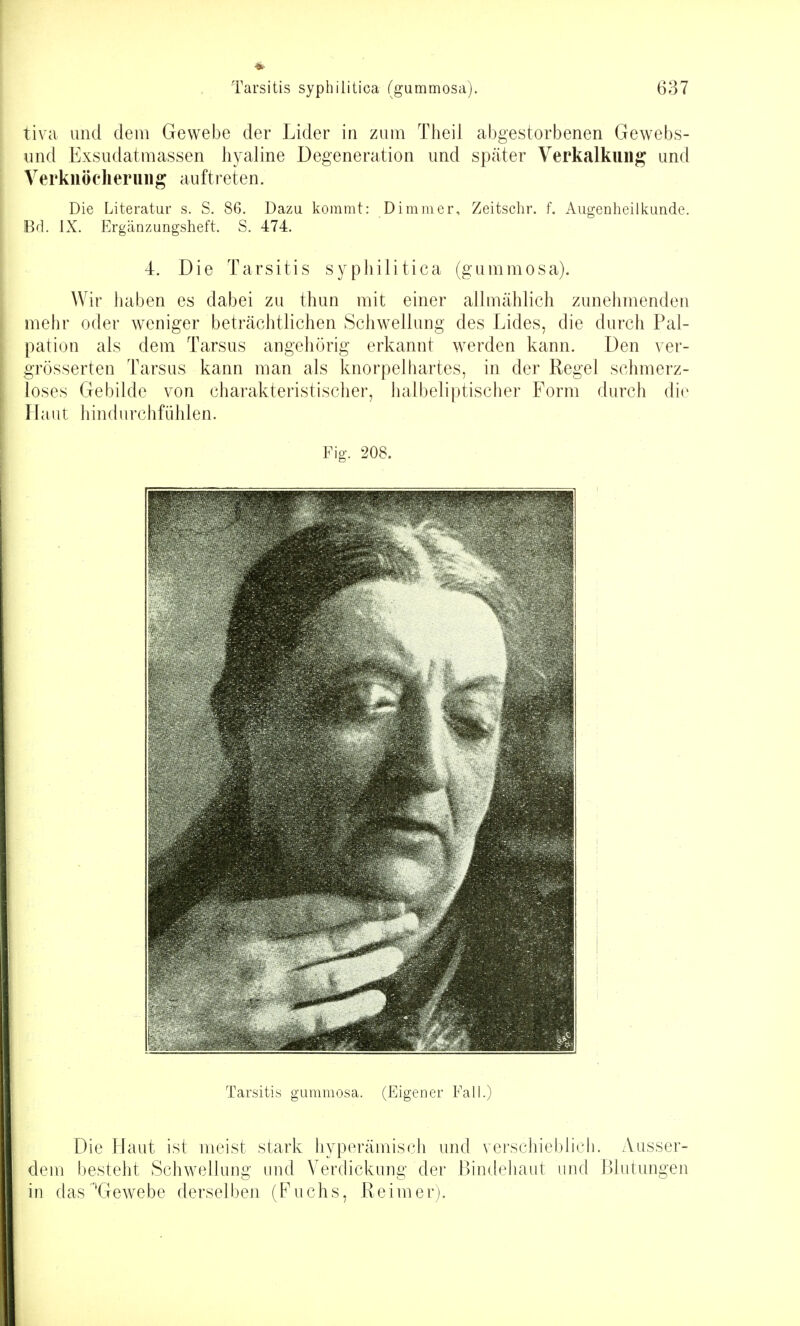 tiva und dem Gewebe der Lider in zum Theil abgestorbenen Gewebs- imd Exsudatmassen hyaline Degeneration und später Verkalkung und Verkiiöeheriiiig auftreten. Die Literatur s. S. 86. Dazu kommt: Dimmer, Zeitschr. f. Augenheilkunde. Bd. IX. Ergänzungsheft. S. 474. 4. Die Tarsitis syphilitica (gummosa). Wir haben es dabei zu thun mit einer allmählich zunehmenden mehr oder weniger beträchtlichen Schwellung des Lides, die durch Pal- pation als dem Tarsus angehörig erkannt werden kann. Den ver- grösserten Tarsus kann man als knorpelhartes, in der Regel schmerz- loses Gebilde von charakteristischer, halbeliptischer Form durch die Haut hindurchfühlen. Fig. 208. Tarsitis gummosa. (Eigener Fall.) Die Haut ist meist stark hyperämisch und verschieblicti. Ausser- dem besteht Schwellung und Verdickung der Bindehaut und Blutungen in das''Gewebe derselben (Fuchs, Reimer).