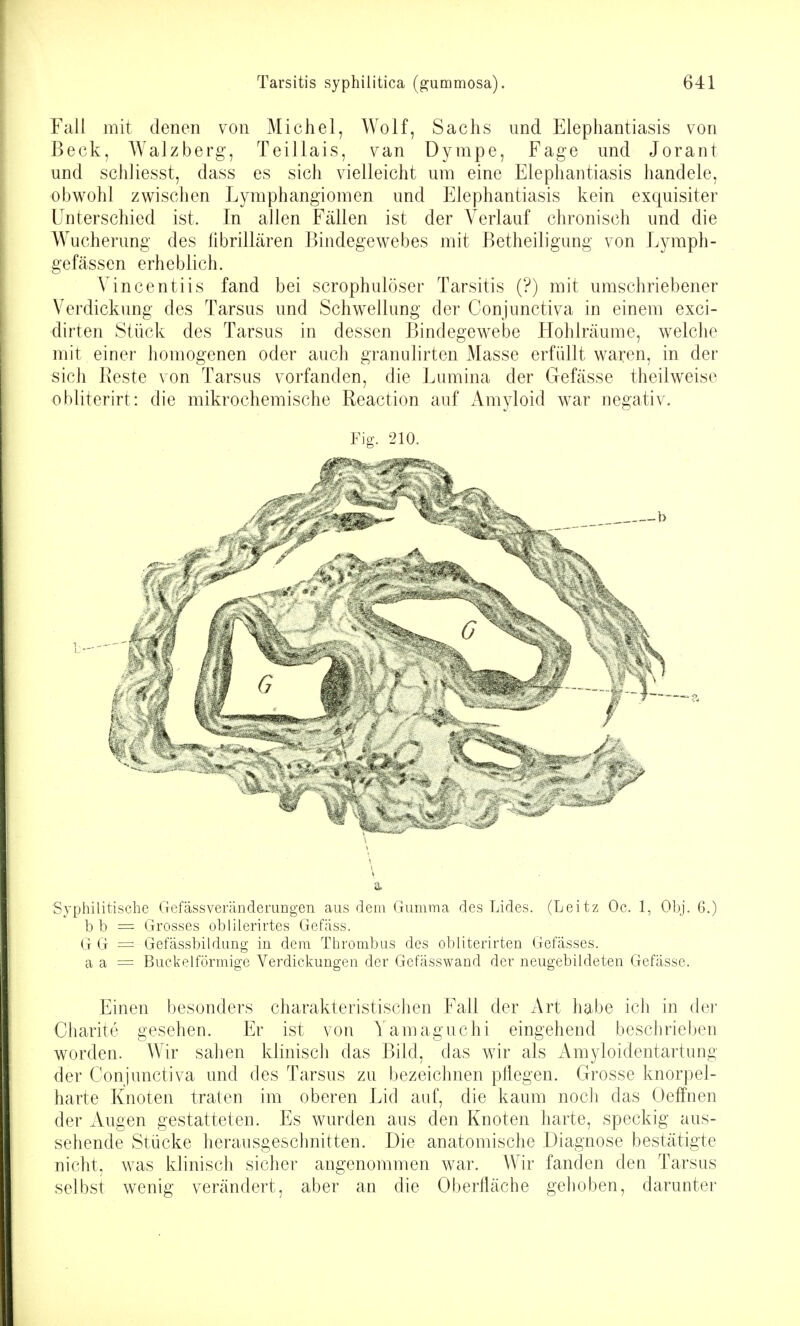 Fall mit denen von Michel, Wolf, Sachs und Elephantiasis von Beck, Walzberg, Teillais, van Dympe, Fage und Jorant und schliesst, dass es sich vielleicht um eine Elephantiasis handele, obwohl zwischen Lymphangiomen und Elephantiasis kein exquisiter Unterschied ist. In allen Fällen ist der Verlauf chronisch und die Wucherung des fibrillären Bindegewebes mit Betheiligung von Lymph- gefässen erheblich. Vincentiis fand bei scrophulöser Tarsitis (?) mit umschriebener Verdickung des Tarsus und Schwellung der Conjunctiva in einem exci- dirten Stück des Tarsus in dessen Bindegewebe Hohlräume, welche mit einer homogenen oder auch granulirten Masse erfüllt waren, in der sich Reste von Tarsus vorfanden, die Lumina der Gefässe theilweise obliterirt: die mikrochemische Reaction auf Amyloid war negativ. Fig. 210. 1. Syphilitische Gefässveränderungen aus dem Gumma des Lides. (Leitz Oc. 1, Obj. 6.) b b = Grosses oblilerirtes Gefäss. G G = Gefässbildung in dem Thrombus des obliterirten Gelasses, a a = Buekelförmige Verdickungen der Gefässwand der neugebildeten Gefässe. Einen besonders charakteristischen Fall der Art habe ich in der Charite gesehen. Er ist von Yamaguchi eingehend beschrieben worden. Wir sahen kliniscli das Bild, das wir als Amyloidentartung der Conjunctiva und des Tarsus zu bezeichnen pHegen. Grosse knorpel- harte Knoten traten im oberen Lid auf, die kaum noch das Oeffnen der Augen gestatteten. Es wurden aus den Knoten harte, speckig aus- sehende Stücke herausgeschnitten. Die anatomische Diagnose bestätigte nicht, was klinisch sicher angenommen war. Wir fanden den Tarsus selbst wenig verändert, aber an die Oberfläche gehoben, darunter