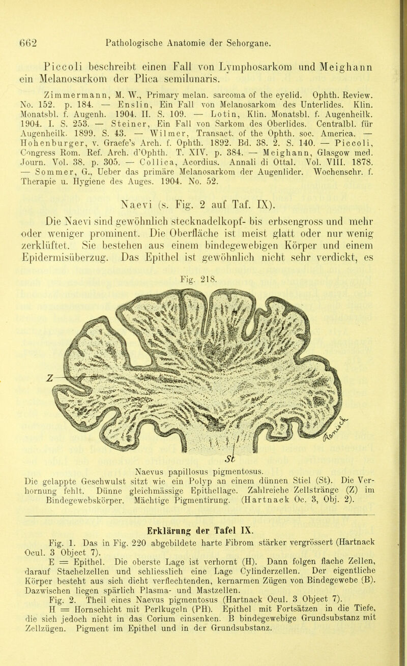 Piccoli beschreibt einen Fall von Lymphosarkom und Meighann ein Melanosarkom der Plica semilunaris. Zimmermann, M. W., Primary melan. sarcoma of the eyelid. Ophth. Review. No. 152. p. 184. — EnsliQ, Ein Fall von Melanosarkom des Unterlides. Klin. Monatsbl. f. Augenh. 1904. II. S. 109. — Lotin, Klin. Monatsbl. f. Augenheilk. 1904. I. S. 253. — Steiner, Ein Fall von Sarkom des Oberlides. Centralbl. für Augenheilk. 1899. S. 43. — Wilmer, Transact. of the Ophth. soc. America. — Hohenburger, v. Graefe's Arch. f. Ophth. 1892. Bd. 38. 2. S. 140. — Piccoli, Congress Rom. Ref. Arch. d'Ophth. T. XIV. p. 384. — Meighann, Glasgow med. Journ. Vol. 38. p. 305. — Collica, Acordius. Annali di Ottal. Vol. VHI. 1878. — Sommer, G., Ueber das primäre Melanosarkom der Augenlider. Wochenschr. f. Therapie u. Hygiene des Auges. 1904. No. 52. Naevi (s. Fig. 2 auf Taf. IX). Die Naevi sind gewöhnlich Stecknadelkopf- bis erbsengross und mehr oder weniger prominent. Die Oberfläche ist meist glatt oder nur wenig zerklüftet. Sie bestehen aus einem bindegewebigen Körper und einem Epidermisüberzug. Das Epithel ist gewöhnlich nicht sehr verdickt, es Fig. 218. St Naevus papillosus pigmentosus. Die gelappte Geschwulst sitzt wie ein Polyp an einem dünnen Stiel (St). Die Ver- hornung fehlt. Dünne gleichmässige Epithellage. Zahlreiche Zellsträüge (Z) im Bindegewebskörper. Mächtige PigmentiruDg. (Hartnack Oc. 3, Obj. 2). Erklärung der Tafel IX. Fig. 1. Das in Fig. 220 abgebildete harte Fibrom stärker vergrössert (Hartnack Ocul. 3 Object 7). E = Epithel. Die oberste Lage ist verhornt (H). Dann folgen flache Zellen, darauf Stachelzellen und schliesslich eine Lage (3ylinderzellen. Der eigentliche Körper besteht aus sich dicht verflechtenden, kernarmen Zügen von Bindegewebe (B). Dazwischen liegen spärlich Plasma- und Mastzellen. Fig. 2. Theil eines Naevus pigmentosus (Hartnack Ocul. 3 Object 7). H = Hornschicht mit Perlkugeln (PH). Epithel mit Fortsätzen in die Tiefe, die sich jedoch nicht in das Corium einsenken. B bindegewebige Grundsubstanz mit Zellzügen. Pigment im Epithel und in der Grundsubstanz.