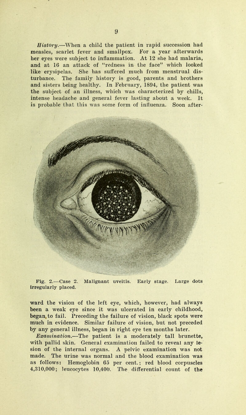 History.—When a child the patient in rapid succession had measles, scarlet fever and smallpox. For a year afterwards her eyes were subject to inflammation. At 12 she had malaria, and at 16 an attack of redness in the face which looked like erysipelas. She has suffered much from menstrual dis- turbance. The family history is good, parents and brothers and sisters being healthy. In February, 1894, the patient was the subject of an illness, which was characterized by chills, intense headache and general fever lasting about a week. It is probable that this was some form of influenza. Soon after- Fig. 2.—Case 2. Malignant uveitis. Early stage. Large dots irregularly placed. ward the vision of the left eye, which, however, had always been a weak eye since it was ulcerated in early childhood, began,to fail. Preceding the failure of vision, black spots were much in evidence. Similar failure of vision, but not preceded by any general illness, began in right eye ten months later. Examination.—The patient is a moderately tall brunette, with pallid skin. General examination failed to reveal any le- sion of the internal organs. A pelvic examination was not made. The urine was normal and the blood examination was as follows: Hemoglobin 65 per cent.; red blood corpuscles 4,310,000; leucocytes 10,400. The differential count of the