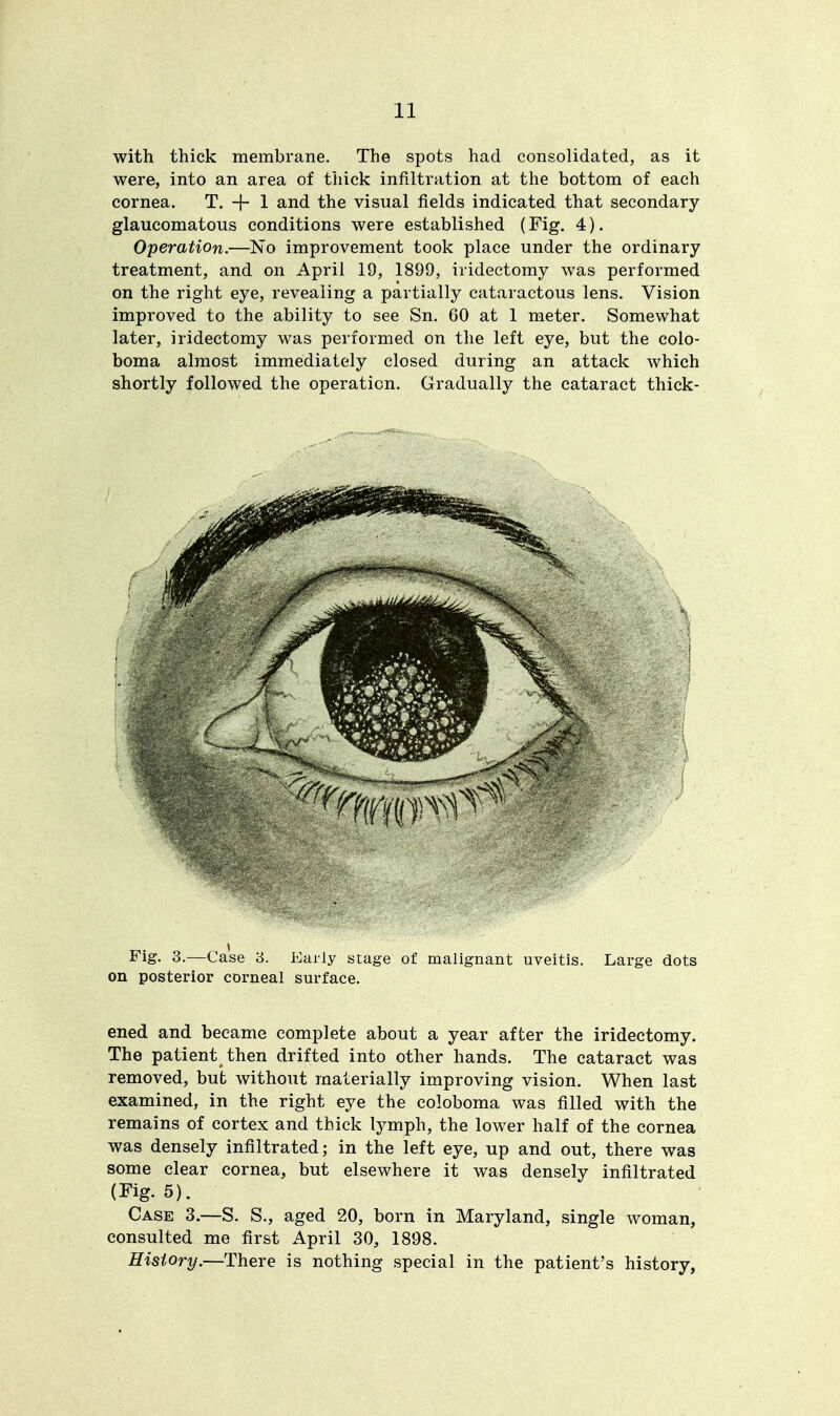 with thick membrane. The spots had consolidated, as it were, into an area of thick infiltration at the bottom of each cornea. T. + 1 and the visual fields indicated that secondary glaucomatous conditions were established (Fig. 4). Operation.—No improvement took place under the ordinary treatment, and on April 19, 1899, iridectomy was performed on the right eye, revealing a partially cataractous lens. Vision improved to the ability to see Sn. 60 at 1 meter. Somewhat later, iridectomy was performed on the left eye, but the colo- boma almost immediately closed during an attack which shortly followed the operation. Gradually the cataract thick- Fig. 3.—Case 3. Early stage of malignant uveitis. Large dots on posterior corneal surface. ened and became complete about a year after the iridectomy. The patient then drifted into other hands. The cataract was removed, but without materially improving vision. When last examined, in the right eye the coloboma was filled with the remains of cortex and thick lymph, the lower half of the cornea was densely infiltrated; in the left eye, up and out, there was some clear cornea, but elsewhere it was densely infiltrated (Fig. 5). Case 3.—S. S., aged 20, born in Maryland, single woman, consulted me first April 30, 1898. History.-—There is nothing special in the patient's history,