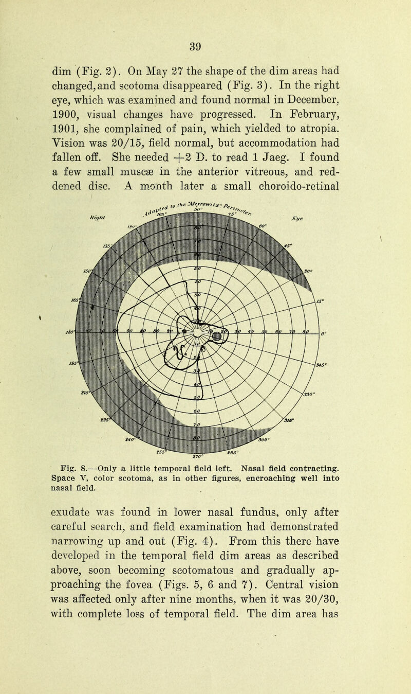 dim (Fig. 2). On May 27 the shape of the dim areas had changed,and scotoma disappeared (Fig. 3). In the right eye, which was examined and found normal in December. 1900, visual changes have progressed. In February, 1901, she complained of pain, which yielded to atropia. Vision was 20/15, field normal, but accommodation had fallen off. She needed +2 D. to read 1 Jaeg. I found a few small muscae in the anterior vitreous, and red- dened disc. A month later a small choroido-retinal Fig. 8.—Only a little temporal field left. Nasal field contracting. Space V, color scotoma, as in other figures, encroaching well into nasal field. exudate was found in lower nasal fundus, only after careful search, and field examination had demonstrated narrowing up and out (Fig. 4). From this there have developed in the temporal field dim areas as described above, soon becoming scotomatous and gradually ap- proaching the fovea (Figs. 5, 6 and 7). Central vision was affected only after nine months, when it was 20/30, with complete loss of temporal field. The dim area has