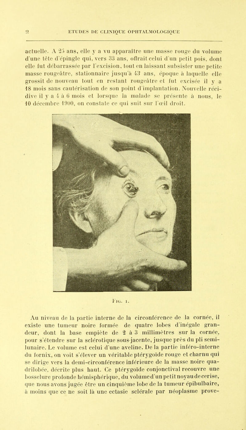 actuelle. A '2-) ans, elle y a vu apparaître une masse rouge clu volume d'une tête d'épingle qui, vers 33 ans, olî'rait celui d'un petit pois, dont elle fut débarrassée par l'excision, tout en laissant subsister une petite masse rougeàtre, stationnaire jusqu'à 43 ans, époque à laquelle elle grossit de nouveau tout en restant rougeàtre et l'ut excisée il y a 48 mois sans cautérisation de son point d'implantation. Nouvelle réci- dive il y a 1 à 6 mois et lorsque la malade se présente à nous, le iO décembre 19oO, on constate ce qui suit sur l'œil droit. FlG. 1. Au niveau de la partie interne de la circonférence de la cornée, il existe une tumeur noire formée de quatre lobes d'inégale gran- deur, dont la base empiète de 2 à 3 millimètres sur la cornée, pour s'étendre sur la sclérotique sous-jacente, jusque près du pli semi- lunaire. Le volume est celui d'une aveline. De la partie inféro-interne du fornix, on voit s'élever un véritable ptérygoïde rouge et charnu qui se dirige vers la demi-circonférence inférieure de la masse noire qua- drilobée, décrite plus haut. Ce ptérygoïde conjonctival recouvre une bosselure profonde hémisphérique, du volumed'unpetitnoyaudecerise, que nous avons jugée être un cinquième lobe de la tumeur épibulbaire, à moins que ce ne soit là une ectasie sclérale par néoplasme prove-