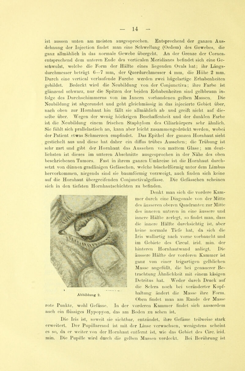 ist aussen unten am meisten ausgesprochen. Entsprechend der ganzen Aus- dehnung der Injection findet man eine Schwellung (Oedem) des Gewebes, die ganz allmählich in das normale Gewebe übergeht. An der Grenze der Cornea, entsprechend dem unteren Ende des verticalen Meridianes befindet sich eine Ge- schwulst, welche die Form der Hälfte eines liegenden Ovals hat; ihr Längs- durchmesser beträgt 6—7 mm, der Querdurchmesser 4 mm, die Höhe 2 mm. Durch eine vertical verlaufende Furche werden zwei hügelartige Erhabenheiten gebildet. Bedeckt wird die Neubildung von der Conjunctiva; ihre Farbe ist glänzend schwarz, nur dre Sjoitzen der beiden Erhabenheiten sind gelbbraun in- folge des Durchschimmerns von im Innern vorhandenen gelben Massen. Die Neubildung ist abgerundet und geht gleichmässig in das injecierte Gebiet über, nach oben zur Hornhaut hin fällt sie allmählich ab und greift nicht auf die- selbe über. Wegen der wenig höckrigen Beschaffenheit und der dunklen Farbe ist die Neubildung einem frischen Staphylom des Ciliarkörpers sehr ähnlich. Sie fühlt sich pralielastisch an, kann aber leicht zusammengedrückt werden, wobei der Patient etwas Schmerzen empfindet. Das Epithel der ganzen Hornhaut sieht gestichelt aus und diese hat daher ein diffus trübes Aussehen; die Trübung ist sehr zart und gibt der Hornhaut das Aussehen von mattem Glase; am deut- lichsten ist dieses im unteren Abschnitte ausgesprochen in der Nähe des oben beschriebenen Tumors. Fast in ihrem ganzen Umkreise ist die Hornhaut durch- setzt von dünnen gradlinigen Gefässchen, welche büschelförmig unter dem Limbus hervorkommen, nirgends sind sie baumförmig verzweigt, auch finden sich keine auf die Hornhaut übergreifenden Conjunctivalgefässe. Die Gefässchen scheinen sich in den tiefsten Hornhaiitschichten zu befinden. Denkt man sich die vordere Kam- mer durch eine Diagonale von der Mitte des äusseren oberen Quadranten zur Mitte des inneren unteren in eine äussere xmd innere Hälfte zerlegt, so findet man, dass die innere Hälfte durchsichtig ist, aber keine normale Tiefe hat, da sich die Iris wallartig nach vorne vorbaucht und im Gebiete des Circul. irid. min. der hinteren Hornhautwand anliegt. Die äussere Hälfte der vorderen Kammer ist ganz von einer teigartigen gelblichen Masse angefüllt, die bei genauerer Be- trachtung Ähnlichkeit mit einem käsigen Detritus hat. Weder durch Druck auf die Sclera noch bei veränderter Kopf- haltung ändert die Masse ihre Form. Oben findet man am Rande der Masse rote Punkte, wohl Gefässe. In der vorderen Kammer findet sich ausserdem auch ein flüssiges Hypopyon, das am Boden zu sehen ist. Die Iris ist, soweit sie sichtbar, entzündet, ihre Gefässe teilweise stark erweitert. Der Pupillarrand ist mit der Linse verwachsen, wenigstens scheint es so, da er weiter von der Hornhaut entfernt ist, wie das Gebiet des Circ. irid. min. Die Pupille wird durch die gelben Massen verdeckt. Bei Berührung ist