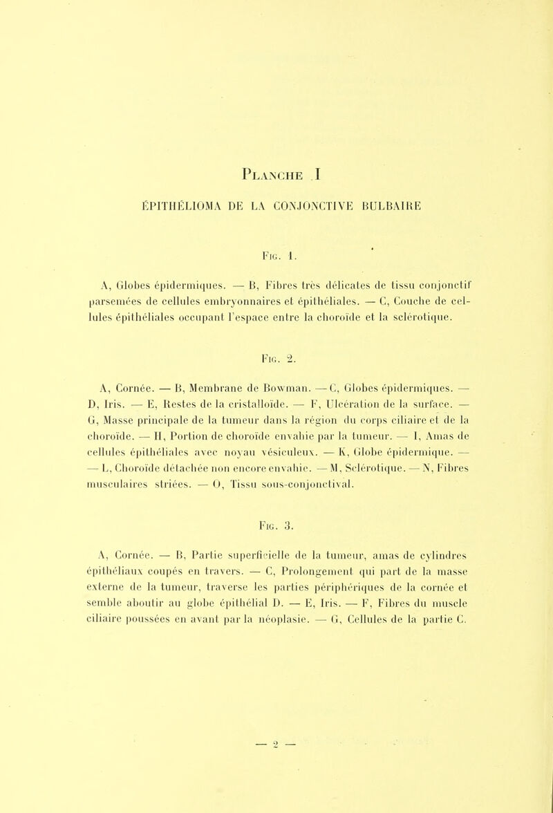 ÉPITHËLIOMA DE LA CONJONCTIVE BULBAIRE FiG. 1. A, Globes épidermiques. — B, Fibres très délicates de tissu conjonctil' parsemées de cellules embryonnaires et épithéliales. — C, Couciie de cel- lules épithéliales occupant l'espace entre la choroïde et la sclérotique. FiG. 2. A, Cornée. — B, Membrane de Bowman. —C, Globes épidermiques. — D, Iris. — E, Restes de la eristalloïde. — ¥, Ulcération de la surface. — G, Masse principale de la tumeur dans la région du corps ciliaire et de la choroïde. — H, Portion de choroïde envahie par la tumeur. — I, Amas de cellules épithéliales avec noyau vésiculeux. — K, Globe épidermique. — —- L, Choroïde détachée non encore envahie. — M, Sclérotique. — N, Fibres musculaires striées. — 0, Tissu sous-conjonctival. FiG. 3. A, Cornée. — B, Partie superficielle de la tumeur, amas de cylindres épithéliaux coupés en travers. — C, Prolongement qui part de la masse externe de la tumeur, traverse les parties périphériques de la cornée et semble aboutir au globe épithélial D. — E, Iris. — F, Fibres du muscle ciliaire poussées en avant parla néoplasie. — G, Cellules de la partie C.