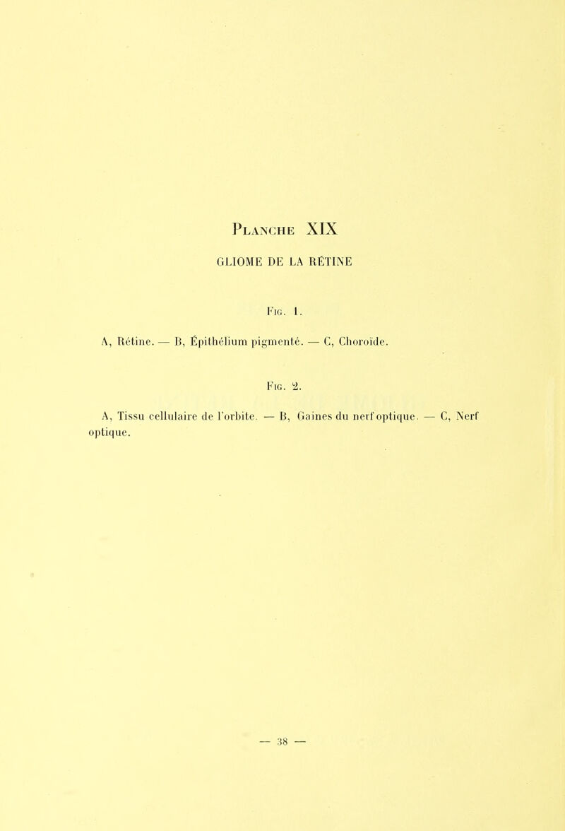 GLIOME DE LA RËTINE FiG. 1. A, Rétine. — B, Épithélium pigmenté. — C, Choroïde. FiG. 2. A, Tissu cellulaire de l'orbite. — B, Gaines du nerlopti([ue. — C, Nerf optique.