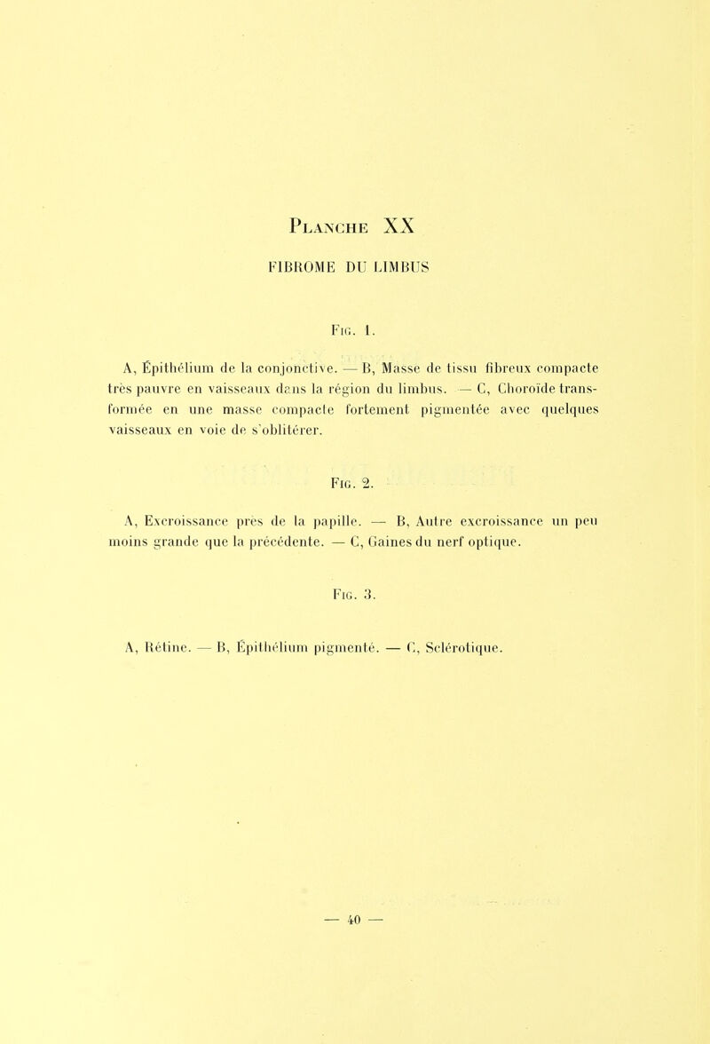 FIBROME DU LIMBUS FlG. 1. A, Épithélium de la conjonctive. — B, Masse de tissu fibreux compacte très pauvre en vaisseaux dans la région du limbus. — C, Choroïde trans- formée en une masse compacle fortement pigmentée avec quelques vaisseaux en voie de s'oblitérer. FiG. 2. A, Excroissance près de la papille. — B, Autre excroissance un peu moins grande que la précédente. — C, Gaines du nerf optique. FiG. 3. A, Rétine. — B, Épithélium pigmenté. — C, Sclérotique.