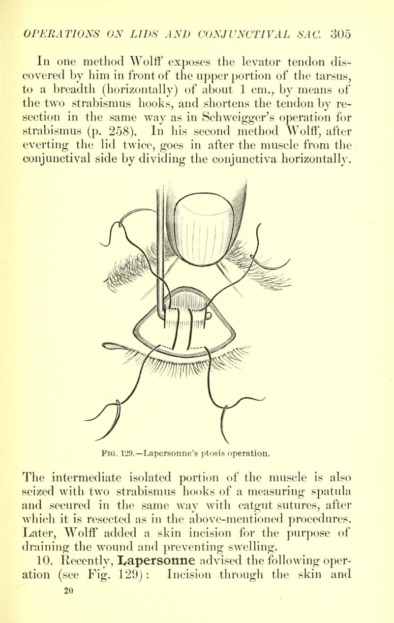 In one method Wolff exposes the levator tendon dis- covered by him in front of the upper portion of the tarsus, to a breadth (horizontally) of about 1 cm., by means of the two strabismus hooks, and shortens the tendon by re- section in the same way as in Schweigger's operation for strabismus (p. 258). In his second method Wolff, after everting the lid twice, goes in after the muscle from the conjunctival side by dividing the conjunctiva horizontally. Fig. 129.—Lapersonne's ptosis operation. The intermediate isolated portion of the muscle is also seized with two strabismus hooks of a measuring spatula and secured in the same way with catgut sutures, after which it is resected as in the above-mentioned procedures. Later, Wolff added a skin incision for the purpose of draining the wound and preventing swelling. 10. Recently, I,apersonne advised the following oper- ation (see Fig. 129): Incision through the skin and 20