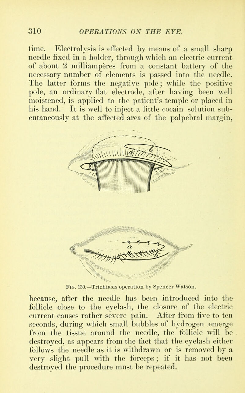 time. Electrolysis is effected by means of a small sharp needle fixed in a holder, through which an electric current of about 2 milliamperes from a constant battery of the necessary number of elements is passed into the needle. The latter forms the negative pole; while the positive pole, an ordinary flat electrode, after having been well moistened, is applied to the patient's temple or placed in his hand. It is well to inject a little cocain solution sub- cutaneously at the affected area of the palpebral margin, Fig. 130.—Trichiasis operation by Spencer Watson. because, after the needle has been introduced into the follicle close to the eyelash, the closure of the electric current causes rather severe pain. After from five to ten seconds, during which small bubbles of hydrogen emerge from the tissue around the needle, the follicle will be destroyed, as appears from the fact that the eyelash either follows the needle as it is withdrawn or is removed by a very slight pull with the forceps; if it has not been destroyed the procedure must be repeated.