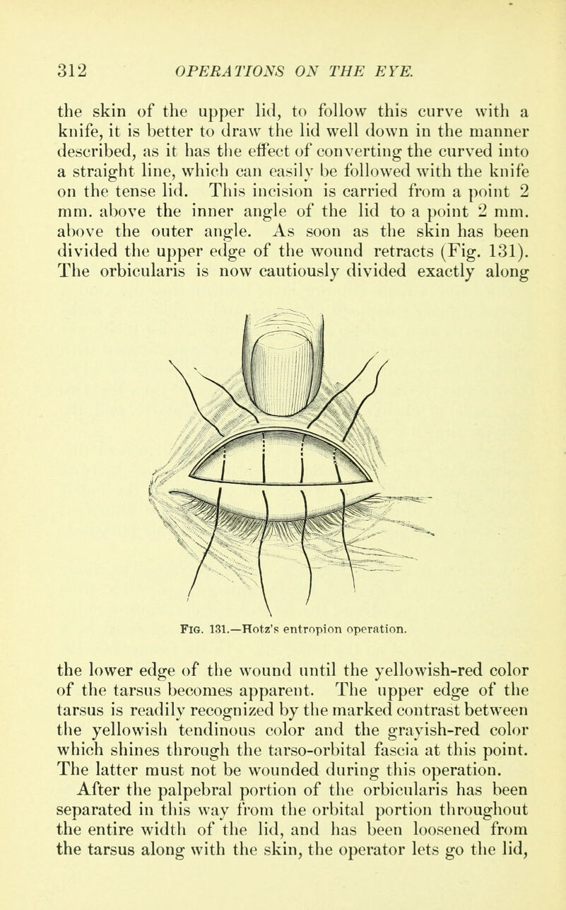 the skin of the upper lid, to follow this curve with a knife, it is better to draw the lid well down in the manner described, as it has the effect of converting the curved into a straight line, which can easily be followed with the knife on the tense lid. This incision is carried from a point 2 mm. above the inner angle of the lid to a point 2 mm. above the outer angle. As soon as the skin has been divided the upper edge of the wound retracts (Fig. 131). The orbicularis is now cautiously divided exactly along Fig. 131.—Hotz's entropion operation. the lower edge of the wound until the yellowish-red color of the tarsus becomes apparent. The upper edge of the tarsus is readily recognized by the marked contrast between the yellowish tendinous color and the grayish-red color which shines through the tarso-orbital fascia at this point. The latter must not be wounded during this operation. After the palpebral portion of the orbicularis has been separated in this way from the orbital portion throughout the entire width of the lid, and has been loosened from the tarsus along with the skin, the operator lets go the lid,