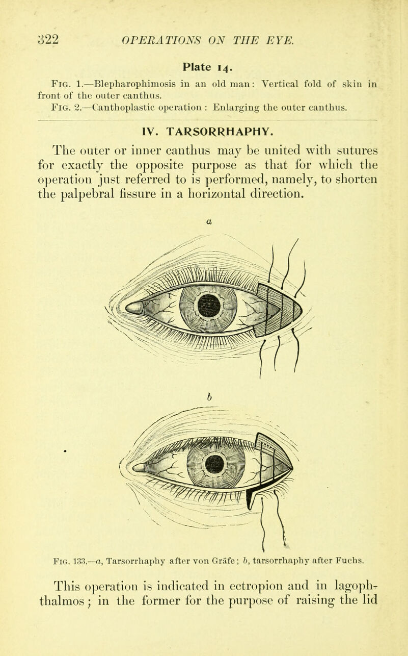 Plate 14, Fig. 1.—Blepharophimosis in an old man: Vertical fold of skin in front of the outer canthus. Fig. 2.—Canthoplastic operation : Enlarging the outer canthus. IV. TARSORRHAPHY. The outer or inner canthus may be united with sutures for exactly the opposite purpose as that for which the operation just referred to is performed, namely, to shorten the palpebral fissure in a horizontal direction. a This operation is indicated in ectropion and in lagoph- thalmos; in the former for the purpose of raising the lid