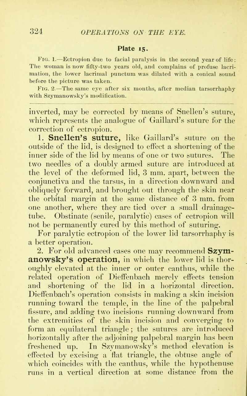 Plate 15. Fig. 1.—Ectropion due to facial paralysis in the second year of life: The woman is now fifty-two years old, and complains of profuse lacri- mation, the lower lacrimal punctum was dilated with a conical sound before the picture was taken. Fig. 2.—The same eye after six mouths, after median tarsorrhaphy with Szymanowsky's modification. inverted, may be corrected by means of Snellen's suture, which represents the analogue of Gaillard's suture for the correction of ectropion. 1. Snellen's suture, like Gaillard's suture on the outside of the lid, is designed to effect a shortening of the inner side of the lid by means of one or two sutures. The two needles of a doubly armed suture are introduced at the level of the deformed lid, 3 mm. apart, between the conjunctiva and the tarsus, in a direction downward and obliquely forward, and brought out through the skin near the orbital margin at the same distance of 3 mm. from one another, where they are tied over a small drainage- tube. Obstinate (senile, paralytic) cases of ectropion will not be permanently cured by this method of suturing. For paralytic ectropion of the lower lid tarsorrhaphy is a better operation. 2. For old advanced cases one may recommend S^ytti- anowsky's operation, in which the lower lid is thor- oughly elevated at the inner or outer canthus, while the related operation of Dieffenbach merely effects tension and shortening of the lid in a horizontal direction. Dieffenbach's operation consists in making a skin incision running toward the temple, in the line of the palpebral fissure, and adding two incisions running downward from the extremities of the skin incision and converging to form an equilateral triangle; the sutures are introduced horizontally after the adjoining palpebral margin lias been freshened up. In Szymanowsky's method elevation is effected by excising a fiat triangle, the obtuse angle of which coincides with the canthus, while the hypothenuse runs in a vertical direction at some distance from the