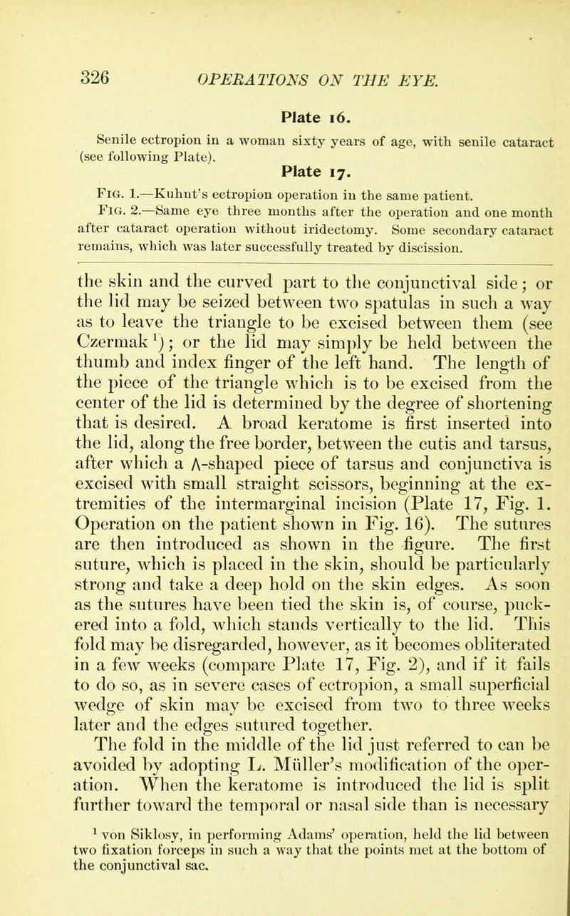 Plate 16. Senile ectropion in a woman sixty years of age, with senile cataract (see following Plate). Plate 17. Fig. 1.—Kuhnt's ectropion operation in the same patient. Fig. 2—Same eye three months after the operation and one month after cataract operation without iridectomy. Some secondary cataract remains, which was later successfully treated by discission. the skin and the curved part to the conjunctival side; or the lid may be seized between two spatulas in such a way as to leave the triangle to be excised between them (see Czermak r); or the lid may simply be held between the thumb and index finger of the left hand. The length of the piece of the triangle which is to be excised from the center of the lid is determined by the degree of shortening that is desired. A broad keratome is first inserted into the lid, along the free border, between the cutis and tarsus, after which a A-shaped piece of tarsus and conjunctiva is excised with small straight scissors, beginning at the ex- tremities of the intermarginal incision (Plate 17, Fig. 1. Operation on the patient shown in Fig. 16). The sutures are then introduced as shown in the figure. The first suture, which is placed in the skin, should be particularly strong and take a deep hold on the skin edges. As soon as the sutures have been tied the skin is, of course, puck- ered into a fold, which stands vertically to the lid. This fold may be disregarded, however, as it becomes obliterated in a few weeks (compare Plate 17, Fig. 2), and if it fails to do so, as in severe cases of ectropion, a small superficial wedge of skin may be excised from two to three weeks later and the edges sutured together. The fold in the middle of the lid just referred to can be avoided by adopting L. Midler's modification of the oper- ation. When the keratome is introduced the lid is split further toward the temporal or nasal side than is necessary 1 von Siklosy, in performing Adams' operation, held the lid between two fixation forceps in such a way that the points met at the bottom of the conjunctival sac.