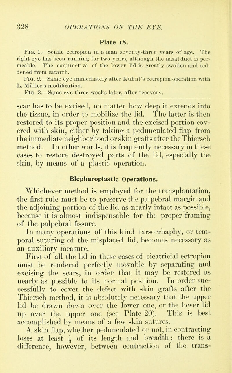 Plate i8. Fig. 1.—Senile ectropion in a man seventy-three years of age. The right eye has been running for two years, although the nasal duct is per- meable. The conjunctiva of the lower lid is greatly swollen and red- dened from catarrh. Fig. 2.—Same eye immediately after Kuhnt's ectropion operation with L. Miiller's modification. Fig. 3.—Same eye three weeks later, after recovery. scar has to be excised, no matter how deep it extends into the tissue, in order to mobilize the lid. The latter is then restored to its proper position and the excised portion cov- ered with skin, either by taking a pedunculated flap from the immediate neighborhood or skin grafts after the Thiersch method. In other words, it is frequently necessary in these cases to restore destroyed parts of the lid, especially the skin, by means of a plastic operation. Blepharoplastic Operations. Whichever method is employed for the transplantation, the first rule must be to preserve the palpebral margin and the adjoining portion of the lid as nearly intact as possible, because it is almost indispensable for the proper framing of the palpebral fissure. In many operations of this kind tarsorrhaphy, or tem- poral suturing of the misplaced lid, becomes necessary as an auxiliary measure. First of all the lid in these cases of cicatricial ectropion must be rendered perfectly movable by separating and excising the scars, in order that it may be restored as nearly as possible to its normal position. In order suc- cessfully to cover the defect with skin grafts after the Thiersch method, it is absolutely necessary that the upper lid be drawn down over the lower one, or the lower lid up over the upper one (see Plate 20). This is best accomplished by means of a few skin sutures. A skin flap, whether pedunculated or not, in contracting loses at least J of its length and breadth ; there is a difference, however, between contraction of the trans-