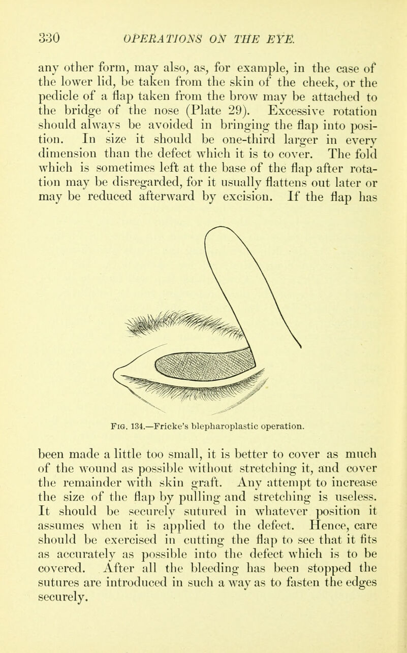 any other form, may also, as, for example, in the case of the lower lid, be taken from the skin of the cheek, or the pedicle of a flap taken from the brow may be attached to the bridge of the nose (Plate 29). Excessive rotation should always be avoided in bringing the flap into posi- tion. In size it should be one-third larger in every dimension than the defect which it is to cover. The fold which is sometimes left at the base of the flap after rota- tion may be disregarded, for it usually flattens out later or may be reduced afterward by excision. If the flap has Fig. 134.—Fricke's blepharoplastic operation. been made a little too small, it is better to cover as much of the wound as possible without stretching it, and cover the remainder with skin graft. Any attempt to increase the size of the flap by pulling and stretching is useless. It should be securely sutured in whatever position it assumes when it is applied to the defect. Hence, care should be exercised in cutting the flap to see that it fits as accurately as possible into the defect which is to be covered. After all the bleeding has been stopped the sutures are introduced in such a way as to fasten the edges securely.