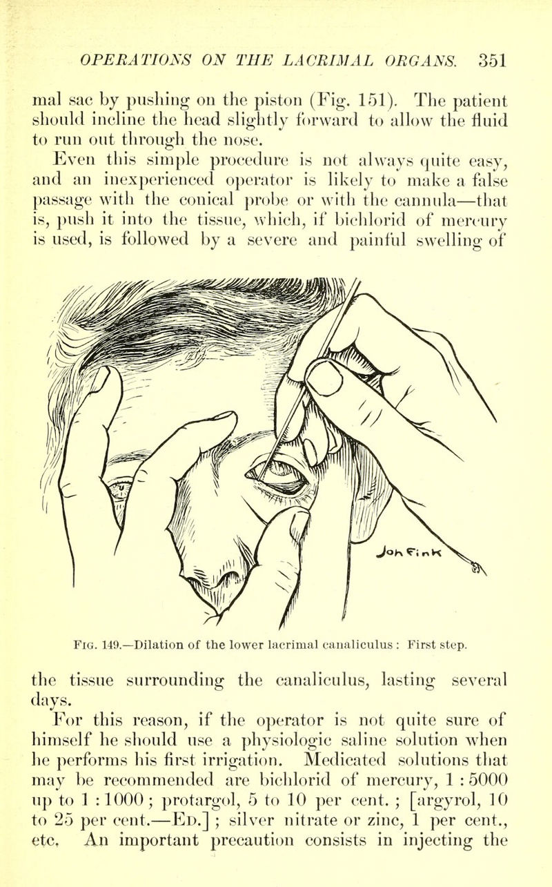 mal sac by pushing on the piston (Fig. 151). The patient should incline the head slightly forward to allow the fluid to run out through the nose. Even this simple procedure is not always quite easy, and an inexperienced operator is likely to make a false passage with the conical probe or with the cannula—that is, push it into the tissue, which, if bichlorid of mercury is used, is followed by a severe and painful swelling of Fig. 149.—Dilation of the lower lacrimal canaliculus : First step. the tissue surrounding the canaliculus, lasting several days. For this reason, if the operator is not quite sure of himself he should use a physiologic saline solution when he performs his first irrigation. Medicated solutions that may be recommended are bichlorid of mercury, 1 :5000 up to 1 :1000; protargol, 5 to 10 per cent. ; [argyrol, 10 to 25 per cent.—Ed.] ; silver nitrate or zinc, 1 per cent., etc. An important precaution consists in injecting the