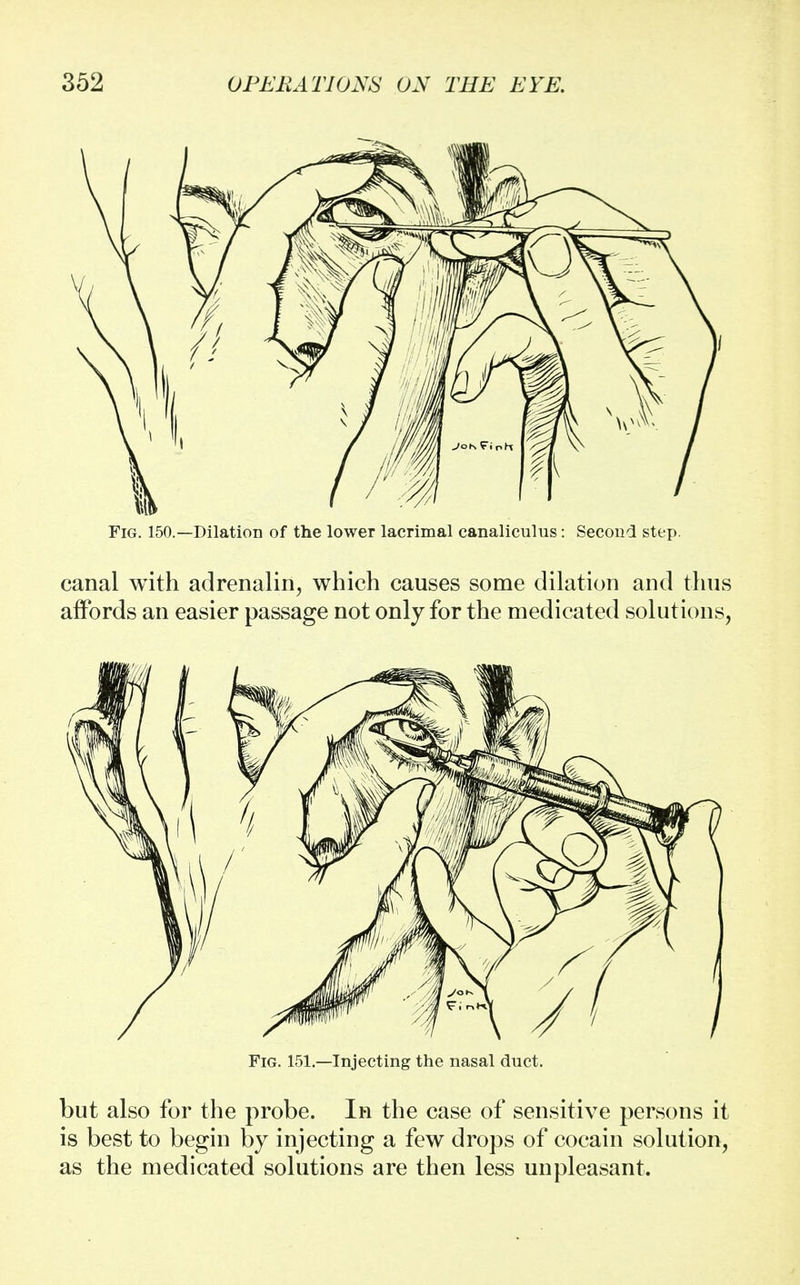 Fig. 150.—Dilation of the lower lacrimal canaliculus: Second step. canal with adrenalin, which causes some dilation and thus affords an easier passage not only for the medicated solutions, Fig. 151.—Injecting the nasal duct. but also for the probe. In the case of sensitive persons it is best to begin by injecting a few drops of cocain solution, as the medicated solutions are then less unpleasant.