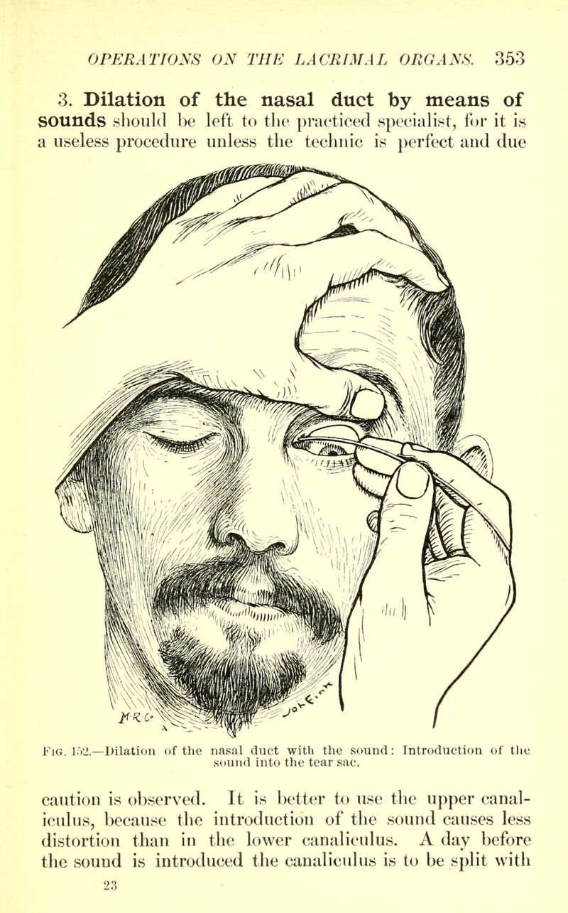 3. Dilation of the nasal duct by means of Sounds should be left to the practiced specialist, for it is a useless procedure unless the technic is perfect and due Fig. 152.—Dilation of the nasal duct with the sound: Introduction of the sound into the tear sac. caution is observed. It is better to use the upper canal- iculus, because the introduction of the sound causes less distortion than in the lower canaliculus. A day before the sound is introduced the canaliculus is to be split with 23