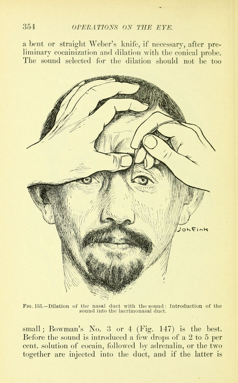 a bent or straight Weber's knife, if necessary, after pre- liminary cocainization and dilation with the conical probe. The sound selected for the dilation should not be too Fig. 153.—Dilation of the nasal duct with the sound: Introduction of the sound into the lacrimonasal duct. small; Bowman's No. 3 or 4 (Fig. 147) is the best. Before the sound is introduced a few drops of a 2 to 5 per cent, solution of cocain, followed by adrenalin, or the two together are injected into the duct, and if the latter is