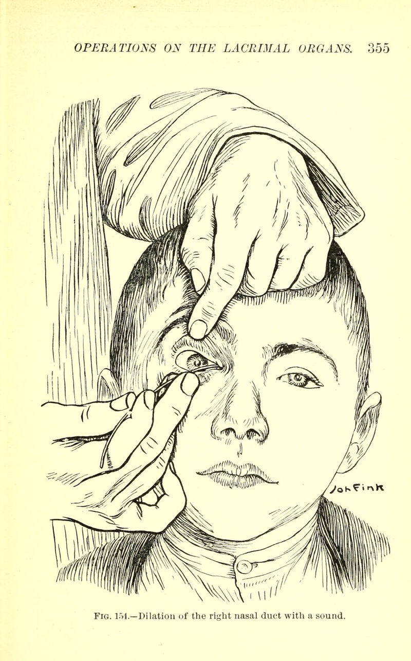 Fig. 151.—Dilation of the right nasal duct with a sound.