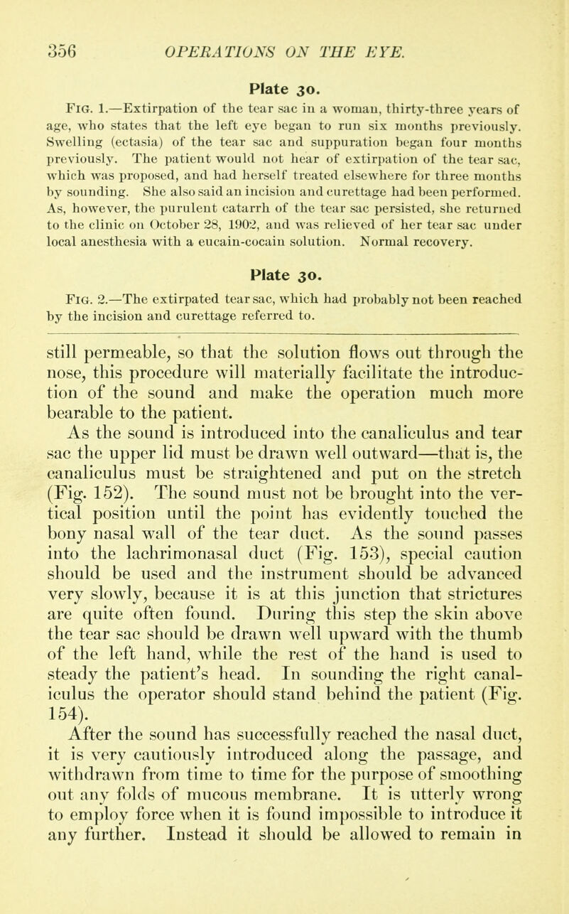 Plate 30. Fig. 1.—Extirpation of the tear sac in a woman, thirty-three years of age, who states that the left eye began to run six months previously. Swelling (ectasia) of the tear sac and suppuration began four months previously. The patient would not hear of extirpation of the tear sac, which was proposed, and had herself treated elsewhere for three months by sounding. She also said an incision and curettage had been performed. As, however, the purulent catarrh of the tear sac persisted, she returned to the clinic on October 28, 1902, and was relieved of her tear sac under local anesthesia with a eucain-cocain solution. Normal recovery. Plate 30. Fig. 2.—The extirpated tear sac, which had probably not been reached by the incision and curettage referred to. still permeable, so that the solution flows out through the nose, this procedure will materially facilitate the introduc- tion of the sound and make the operation much more bearable to the patient. As the sound is introduced into the canaliculus and tear sac the upper lid must be drawn well outward—that is, the canaliculus must be straightened and put on the stretch (Fig. 152). The sound must not be brought into the ver- tical position until the point has evidently touched the bony nasal wall of the tear duct. As the sound passes into the lachrimonasal duct (Fig. 153), special caution should be used and the instrument should be advanced very slowly, because it is at this junction that strictures are quite often found. During this step the skin above the tear sac should be drawn well upward with the thumb of the left hand, while the rest of the hand is used to steady the patient's head. In sounding the right canal- iculus the operator should stand behind the patient (Fig. 154). After the sound has successfully reached the nasal duct, it is very cautiously introduced along the passage, and withdrawn from time to time for the purpose of smoothing out any folds of mucous membrane. It is utterly wrong to employ force when it is found impossible to introduce it any further. Instead it should be allowed to remain in