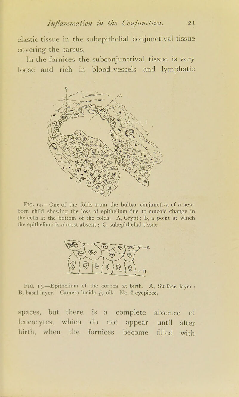elastic tissue in the subepithelial conjunctival tissue covering; the tarsus. In the fornices the subconjunctival tissue is very loose and rich in blood-vessels and lymphatic B Fig. 14.— One of the folds troin the bulbar conjunctiva of a new- bora child showing the loss of epithelium due to mucoid change in the cells at the bottom of the folds. A, Crypt; B, a point at which the epithelium is almost absent; C, subepithelial tissue. Fjg. 15.—Epithelium of the cornea at birth. A, Surface layer ; B, basal layer. Camera lucida oil. No. 8 eyepiece. spaces, but there is a complete absence of leucocytes, which do not appear until after birth, when the fornices become filled with