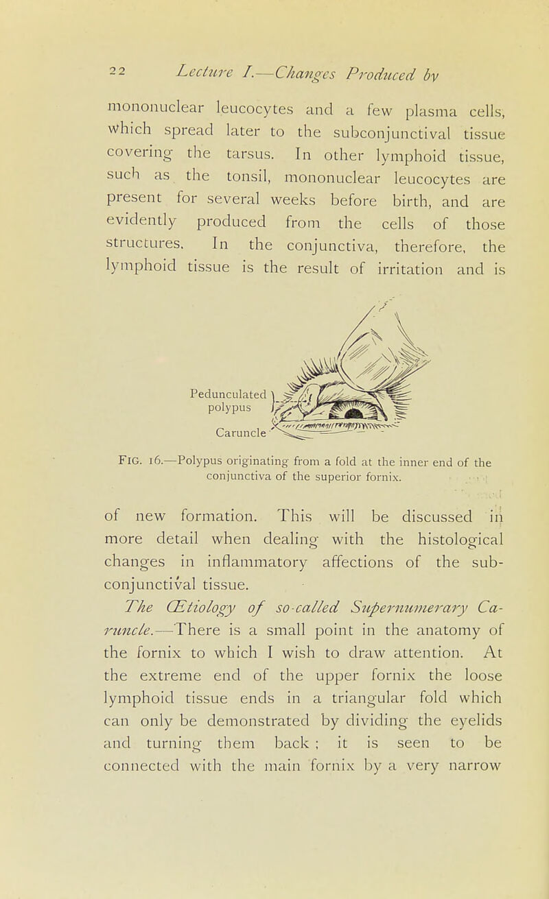 mononuclear leucocytes and a few plasma cells, which spread later to the subconjunctival tissue covering the tarsus. In other lymphoid tissue, such as the tonsil, mononuclear leucocytes are present for several weeks before birth, and are evidently produced from the cells of those structures. In the conjunctiva, therefore, the lymphoid tissue is the result of irritation and is Fig. 16.—Polypus originating from a fold at the inner end of the conjunctiva of the superior fornix. of new formation. This will be discussed in more detail when dealino- with the histological changes in inflammatory affections of the sub- conjunctival tissue. The CEtiology of so-called Siipermimerary Ca- rtmcle.—There is a small point in the anatomy of the fornix to which I wish to draw attention. At the extreme end of the upper fornix the loose lymphoid tissue ends in a triangular fold which can only be demonstrated by dividing the eyelids and turning them back ; it is seen to be connected with the main fornix by a very narrow