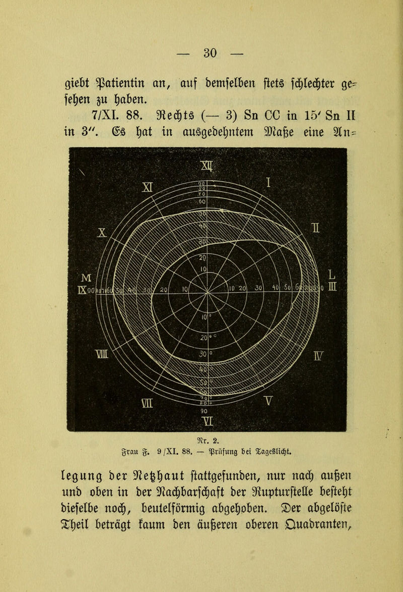 giebt Patientin an, auf bemfelben fietö fä)leäjter ge- legen ju Reiben. 7/XL 88. $ieä)H (— 3) Sn CG in 15' Sn II in 3. @s fjat in auägebefjntem SJtafce eine 2t n^ ^r. 2. grau 9 /XI. 88. — Prüfung Bei £age§Iidjt. legung ber -Jtefetjaut ftattgefunben, nur naef) aufjen unb oben in ber -JJadjbarfd)aft ber ^RupturfteHe befielt biefelbe noä), beuteiförmig abgehoben. ®er abgetöfie SfjetI beträgt faum ben äußeren oberen Quabranten,