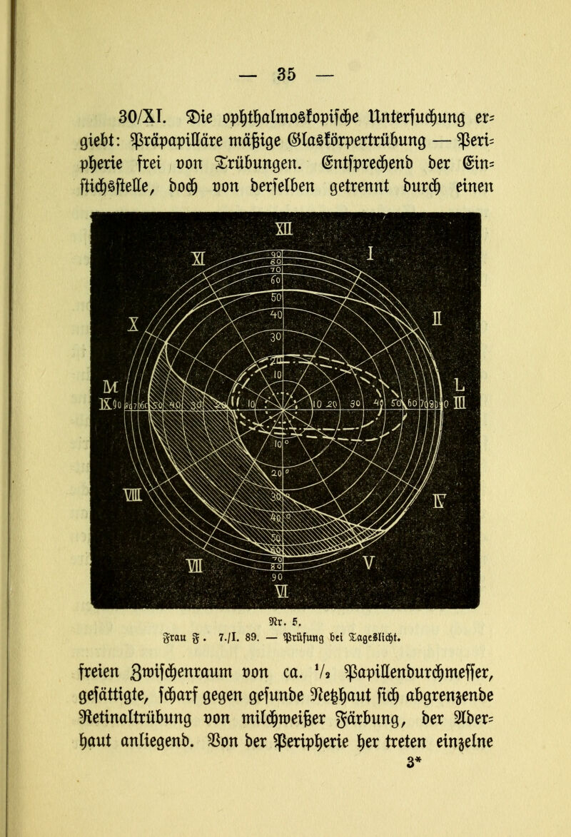 30/XI. ©ie op^tljalmosfoptfdje Unterfudjung er- giebt: ^räpapilläre mäßige (Slasförpertrübung — ^eri= p^erte frei von Trübungen. (Sntfpredjenb ber @in= ftid^ftetle, boäj von berfelben getrennt buräj einen Kr. 5. grau g. 7./I. 89. — Prüfung bei SageSlidjt. freien Swifcfjenraum von ca. V* ^ßapillenburcfjmeffer, gefättigte, fdjarf gegen gefunbe Stfe^aut ftä) abgrenjenbe Sietinaltrübung von mildjroetfcer Färbung, ber 2lber= t)<wt anliegenb. %on ber Sßeriptierie l)er treten einjelne