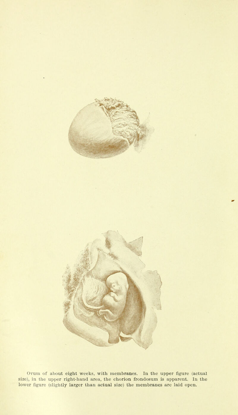 Ovum of about eight weeks, with membranes. In the upper figure (actual size), in the upper right-hand area, the chorion frondosum is apparent. In the lower figure (slightly larger than actual size) the membranes are laid open.
