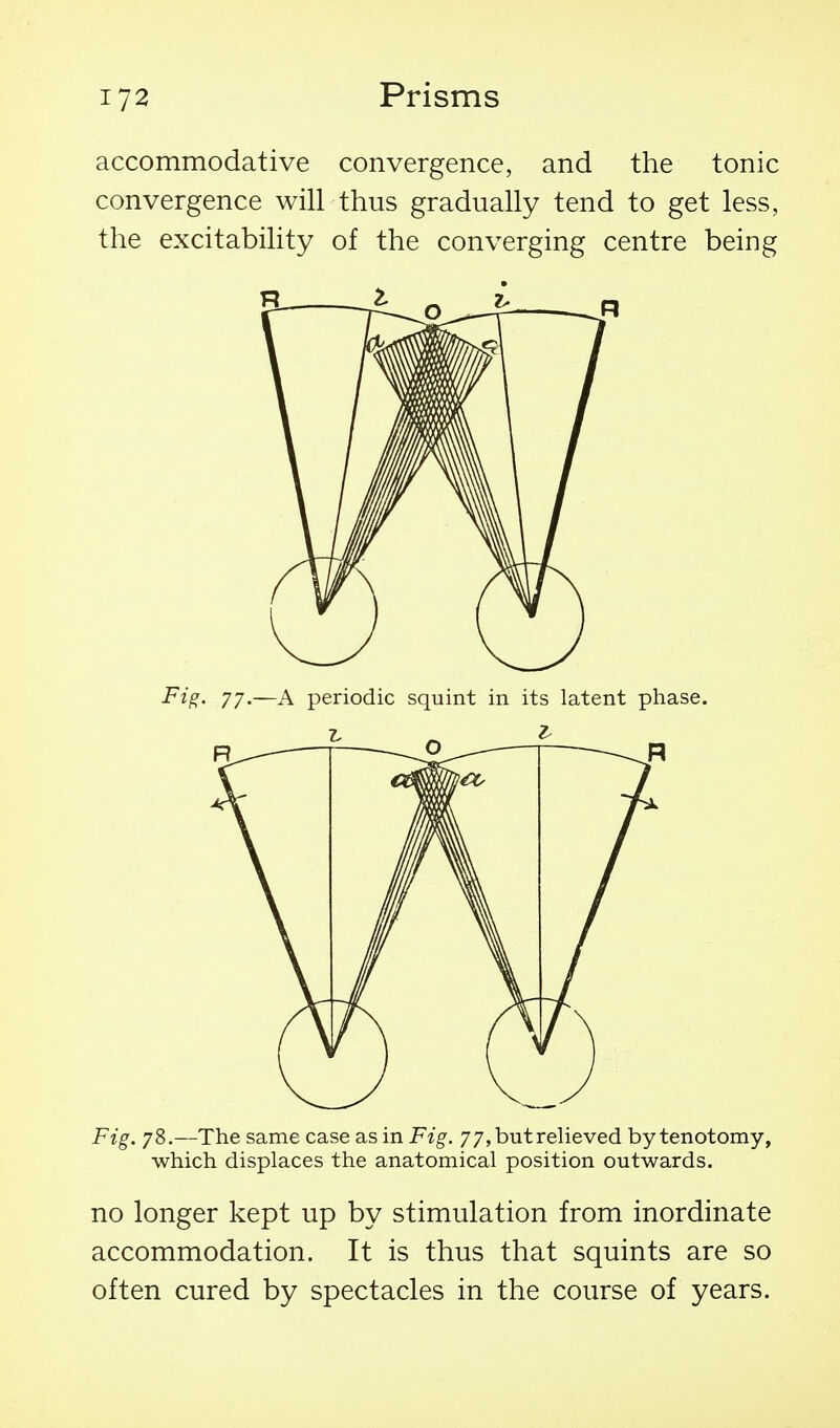 accommodative convergence, and the tonic convergence will thus gradually tend to get less, the excitability of the converging centre being Fi^. 77.—A periodic squint in its latent phase. Fig. 78.—The same case as in Fig. 7 7, but relieved by tenotomy, which displaces the anatomical position outwards. no longer kept up by stimulation from inordinate accommodation. It is thus that squints are so often cured by spectacles in the course of years.