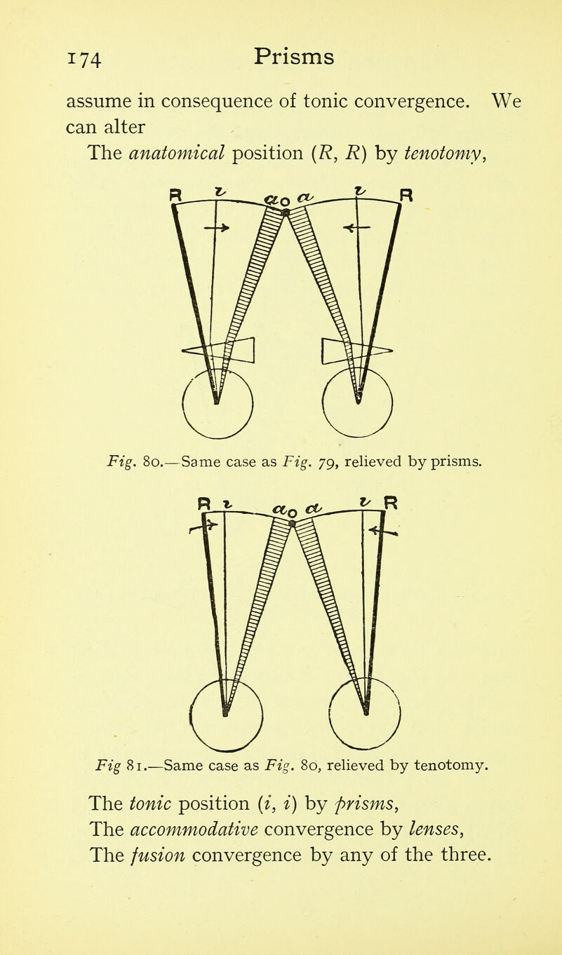 assume in consequence of tonic convergence. We can alter The anatomical position {R, R) by tenotomy, Fig. 80.—Same case as Fig. yg, relieved by prisms. Fig 81.—Same case as Fig. 80, relieved by tenotomy. The tonic position {i, i) by prisms, The accommodative convergence by lenses, The fusion convergence by any of the three.