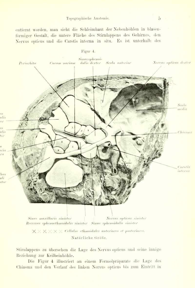 entfernt worden, man sieht die Schleimhaut der Nebenhöhlen in blasen- förmiger Gestalt, die untere Flüche des Stirnlappens des Gehirnes, den Nervus opticus und die Carotis interna in situ. Es ist unterhalb des Figur 4. Sinns sphenoi- Periorbita Canum narium dalis dexter Scala anterior Nereus opticus clexter Sinn* maxillaris sinister Nervus opticus sinister Eecessus sphenoethmoidalis sinister Sinns sphenoidalis sinister X X X X X X Cellulae ethmoidales anteriores et posteriores. Natürliche <i rölie. Stirnlappens zu übersehen die Lage des Nervus opticus und seine innige Beziehung zur Keilbeinhöhle. Die Figur 4 illustriert an einem Formolpräparate die Lage des Ohiasmä und den Verlauf des linken Nervus opticus Iiis zum Eintritt in