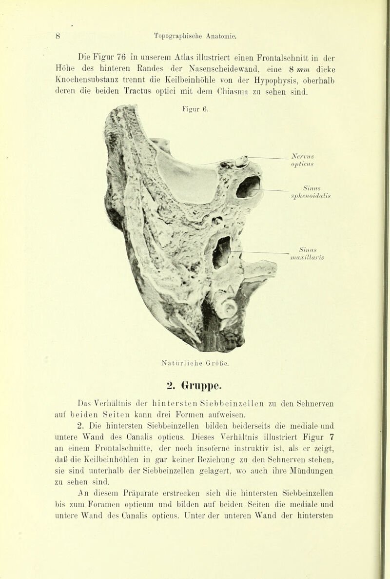 Die Figur 76 in unserem Atlas illustriert einen Frontalschnitt in der Höhe des hinteren Randes der Nasenscheidewand, eine 8 mm dicke Knochensubstanz trennt die Keilbeinhöhle von der Hypophysis, oberhalb deren die beiden Tractus optici mit dem Ohiasma zu sehen sind. Natürliche Größe. 2. Gruppe. Das Verhältnis der hintersten Siebbeinzellen zu den Sehnerven auf beiden Seiten kann drei Formen aufweisen. 2. Die hintersten Siebbeinzellen bilden beiderseits die mediale und untere Wand des Canalis opticus. Dieses Verhältnis illustriert Figur 7 an einem Frontalschnitte, der noch insoferne instruktiv ist, als er zeigt, daß die Keilbeinhöhlen in gar keiner Beziehung zu den Sehnerven stehen, sie sind unterhalb der Siebbeinzellen gelagert, wo auch ihre Mündungen zu sehen sind. An diesem Präparate erstrecken sich die hintersten Siebbeinzellen bis zum Foramen opticum und bilden auf beiden Seiten die mediale und untere Wand des Canalis opticus. Unter der unteren Wand der hintersten