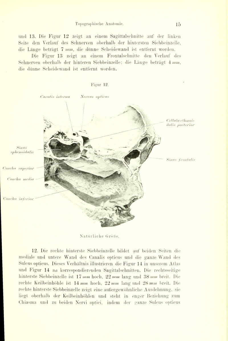 und 13. Die Figur 12 zeigt an einem Sagittalsehnitte auf der linken Seite den Verlauf des Sehnerven oberhalb der hintersten Siebbeinzelle, die Länge beträgt 7 mm, die dünne Seheidewand ist entfernt worden. Die Figur 13 zeigt an einem Frontalschnitte den Verlauf des Sehnerven oberhallt der hinteren Siebbeinzelle: die Länge beträgt 4 mm, die dünne Seheidewand ist entfernt worden. Figur 12. Carotis interna Nervus opticus Natürliche Größe. 12. Die rechte hinterste Siebbeinzelle bildet auf beiden Seiten die mediale und untere Wand des Oanalis opticus und die ganze Wand des Sulcus opticus. Dieses Verhältnis illustrieren die Figur 14 in unserem Atlas und Figur 14 an korrespondierenden Sagittalschnitten. Die rechtsseitige hinterste Siebbeinzelle ist 17 mm hoch, 22?«»* lang und 38mm breit. Die rechte Keilbeinhöhle ist 14?«»* hoch, 22mm lang und 28mm breit. Die rechte hinterste Siebbeinzelle zeigt eine außergewöhnliche Ausdehnung, sie liegt oberhalb der Keilbeinhöhlen und steht in enger Beziehung zum Ohiasma und zu beiden Nervi optici, indem der ganze Sulcus opticus
