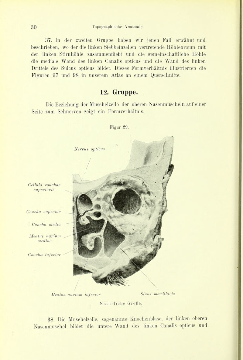 37. In der zweiten Gruppe haben wir jenen Fall erwähnt und beschriebeD, wo der die linken Siebbeinzellen vertretende Höhlenraum mit der linken Stirnhöhle zusammenfließt und die gemeinschaftliche Höhle die mediale Wand des linken Canalis opticus und die Wand des linken Drittels des Suleus opticus bildet. Dieses Pormverhältnis illustrierten die Figuren 97 und 98 in unserem Atlas an einem Querschnitte. 12. Gruppe. Die Beziehung der Muschelzelle der oberen Nasenmuscheln auf einer Seite zum Sehnerven zeigt ein Form Verhältnis. Figur 29. Meatns narium inferior Sinns inaxiUaris Natürliche Größe. 38. Die Muschelzelle, sogenannte Knochenblase, der linken oberen Nasenmuschel bildet die untere Wand des linken Canalis opticus und