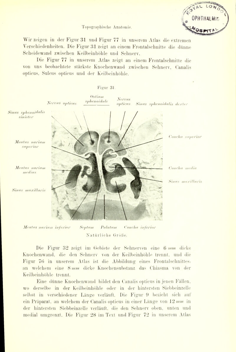 OPHTHALMIA Topographische Anatomie. Wir zeigen in der Figur 31 und Figur 77 in unserem Atlas die extremen Verschiedenheiten. Die Figur 31 zeigt an einem Frontalschnitte die dünne Scheidewand zwischen Keilbeinhöhle und Sehnerv. Die Figur 77 in unserem Atlas zeigt an einem Frontalschnitte die von uns beobachtete stärkste Knochenwand zwischen Sehnerv. Oanälis opticus, Sulcus opticus und der Keilbeinhöhle. Fieur 31. Nervus opticus (>sliniii spJienoidale Nervus opticus Sinus sphenoidalis de,vte, Sin us sphenoidaIis sinister Meatus narium superior Sinns maxillaris Concho superior ( 'oIU'Jki mi tlitt Sinns um.rMaris Meatus narium inferior Septum Palatiini Concha inferior Natürliche Größe. Die Figur 32 zeigt im Gebiete der Sehnerven eine 6 mm dicke Knochenwand, die den Sehnerv von der Keilbeinhöhle trennt, und die Figur 7t) in unserem Atlas ist die Abbildung eines FrontalschnitteSi an welchem eine 8 mm dicke Knochensubstanz das Ohiasma von der Keilbeinhöhle trennt. Eine dünne Knochenwand bildet den Canalis opticus in jenen Fällen, wo derselbe in der Keilbeinhöhle oder in der hintersten Siebbeinzelle selbst in verschiedener Länge verläuft. Die Figur 9 bezieht sich auf ein Präparat, an welchem der Canalis opticus in einer Länge von 12 mm in der hintersten Siebbeinzelle verläuft, die den Sehnerv oben, unten und medial umgrenzt. Die Figur 28 im Text und Figur 72 in unserem Atlas