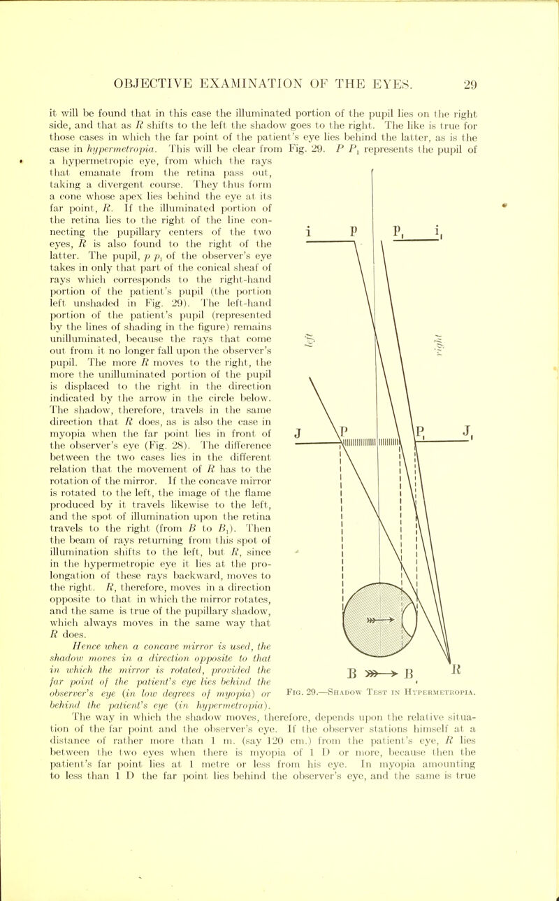 it will be found that in this case the illuminated portion of the pupil lies on the l ight side, and that as R shifts to the left the shadow goes to the right. The like is true for those cases in which the far point of the patient's eye lies behind the latter, as is the case in hypermetropic,. This will be clear from Fig. 29. P Pl represents the pupil of a hypermetropic eye, from which the rays that emanate from the retina pass out, taking a divergent course. They thus form a cone whose apex lies behind the eye at its far point, R. If the illuminated portion of the retina lies to the right of the line con- necting the pupillary centers of the two eyes, R is also found to the right of the latter. The pupil, p p, of the observer's eye takes in only that part of the conical sheaf of rays which corresponds to the right-hand portion of the patient's pupil (the portion left unshaded in Fig. 29). The left-hand portion of the patient's pupil (represented by the lines of shading in the figure) remains unilluminated, because the rays that come out from it no longer fall upon the observer's pupil. The more R moves to the right, the more the unilluminated portion of the pupil is displaced to the right in the direction indicated by the arrow in the circle below. The shadow, therefore, travels in the same direction that R does, as is also the case in myopia when the far point lies in front of the observer's eye (Fig. 28). The difference between the two cases lies in the different relation that the movement of R has to the rotation of the mirror. If the concave mirror is rotated to the left, the image of the flame produced by it travels likewise to the left, and the spot of illumination upon the retina travels to the right (from B to B,). Then the beam of rays returning from this spot of illumination shifts to the left, but R, since in the hypermetropic eye it lies at the pro- longation of these rays backward, moves to the right. R, therefore, moves in a direction opposite to that in which the mirror rotates, and the same is true of the pupillary shadow, which always moves in the same way that R does. Hence when a concave mirror is used, the shadow moves in a, direction opposite to that in which the mirror is rotated, provided the far point of the patient's eye lies behind the observer's eye (in low degrees of myopia) or behind the patient's eye (in hypermetropic,). The way in which the shadow moves, therefore, depends upon the relative situa- tion of the far point and the observer's eye. If the observer stations himself at a distance of rather more than 1 m. (say 120 cm.) from the patient's eye, R lies between the two eyes when there is myopia of 1 D or more, because then the patient's far point lies at 1 metre or less from his eye. In myopia amounting to less than 1 D the far point lies behind the observer's eye, and the same is true