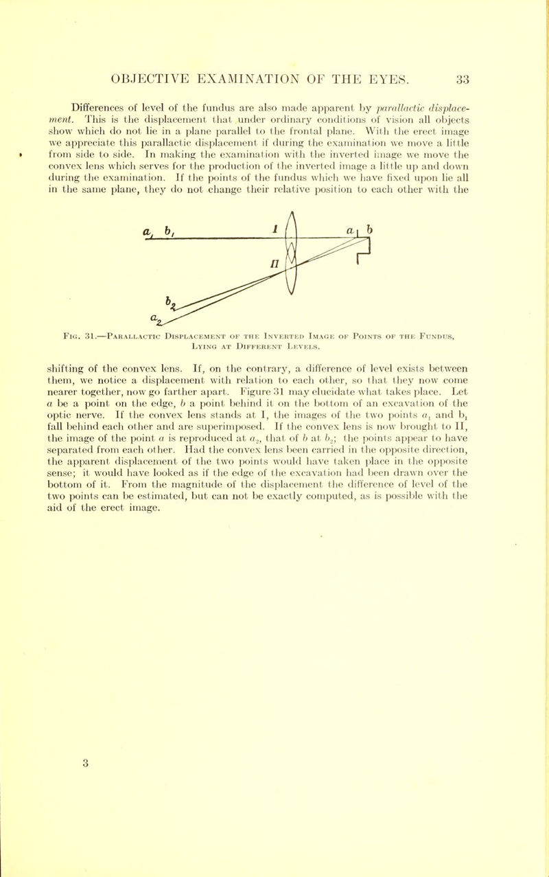 Differences of level of the fundus are also made apparent by -parallactic displace- ment. This is the displacement that under ordinary conditions of vision all objects show which do not lie in a plane parallel to the frontal plane. With the erect image we appreciate this parallactic displacement if during the examination we move a little » from side to side. In making the examination with the inverted image we move the convex lens which serves for the production of the inverted image a little up and down during the examination. If the points of the fundus which we have fixed upon lie all in the same plane, they do not change their relative position to each other with the Fig. 31.—Parallactic Displacement of the Inverted Image of Points of the Fondds, Lying at Different Levels. shifting of the convex lens. If, on the contrary, a difference of level exists between them, we notice a displacement with relation to each other, so that they now come nearer together, now go farther apart. Figure 31 may elucidate what takes place. Let a be a point on the edge, b a point behind it on the bottom of an excavation of the optic nerve. If the convex lens stands at I, the images of the two points «, and b, fall behind each other and are superimposed. If the convex lens is now brought to II, the image of the point a is reproduced at a2, that of b at b.2; the points appear to have separated from each other. Had the convex lens been carried in the opposite direction, the apparent displacement of the two points would have taken place in the opposite sense; it would have looked as if the edge of the excavation had been drawn over the bottom of it. From the magnitude of the displacement, the difference of level of the two points can be estimated, but can not be exactly computed, as is possible with the aid of the erect image. 3