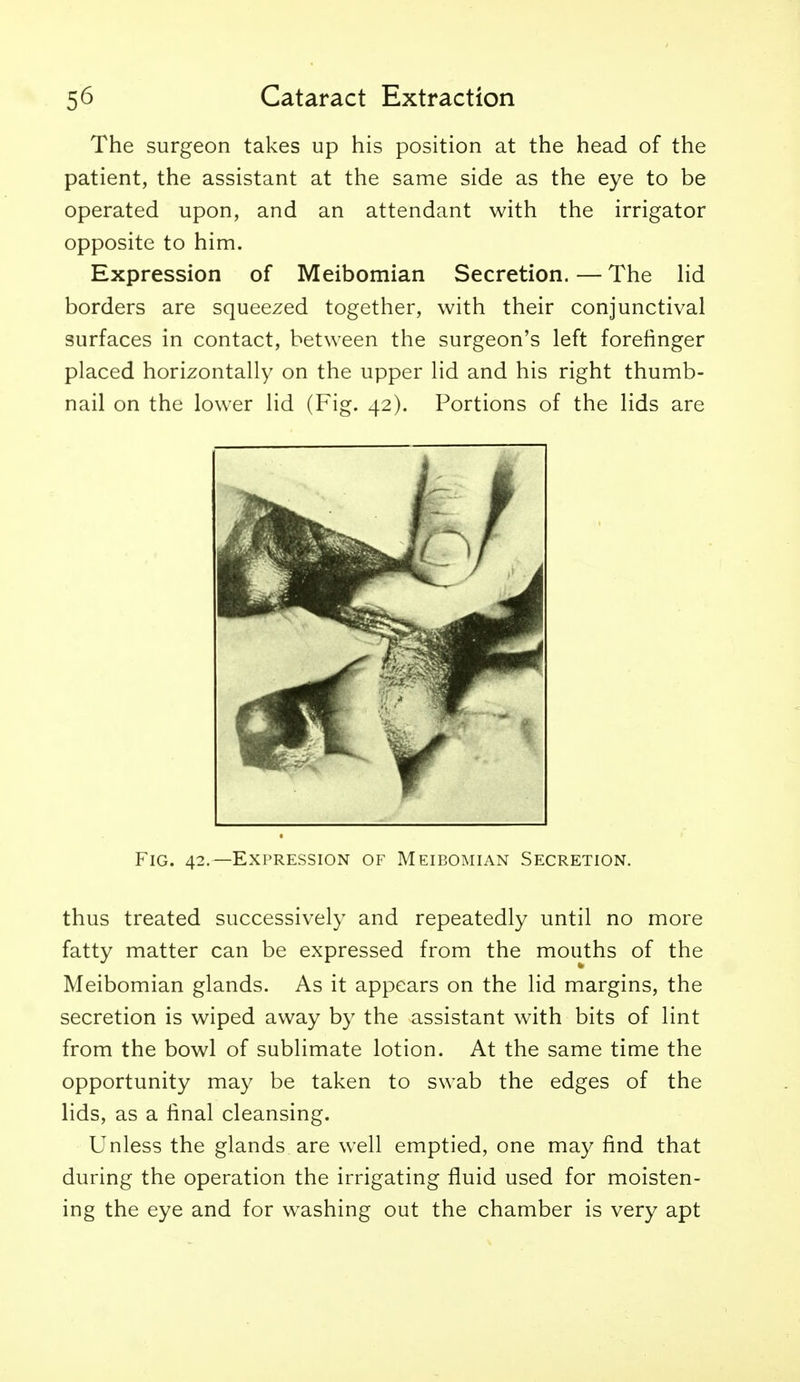 The surgeon takes up his position at the head of the patient, the assistant at the same side as the eye to be operated upon, and an attendant with the irrigator opposite to him. Expression of Meibomian Secretion. — The Hd borders are squeezed together, with their conjunctival surfaces in contact, between the surgeon's left forefinger placed horizontally on the upper lid and his right thumb- nail on the lower lid (Fig. 42). Portions of the lids are Fig. 42.—Expression of Meibomian Secretion. thus treated successively and repeatedly until no more fatty matter can be expressed from the mouths of the Meibomian glands. As it appears on the lid margins, the secretion is wiped away by the assistant with bits of lint from the bowl of sublimate lotion. At the same time the opportunity may be taken to swab the edges of the lids, as a final cleansing. Unless the glands are well emptied, one may find that during the operation the irrigating fluid used for moisten- ing the eye and for washing out the chamber is very apt
