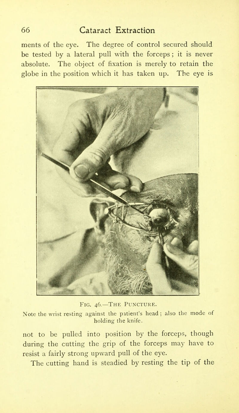 ments of the eye. The degree of control secured should be tested by a lateral pull with the forceps ; it is never absolute. The object of fixation is merely to retain the globe in the position which it has taken up. The eye is Fig. 46.—The Puncture. Note the wrist resting against the patient's head ; also the mode of holding the knife. not to be pulled into position by the forceps, though during the cutting the grip of the forceps may have to resist a fairly strong upward pull of the eye. The cutting hand is steadied by resting the tip of the