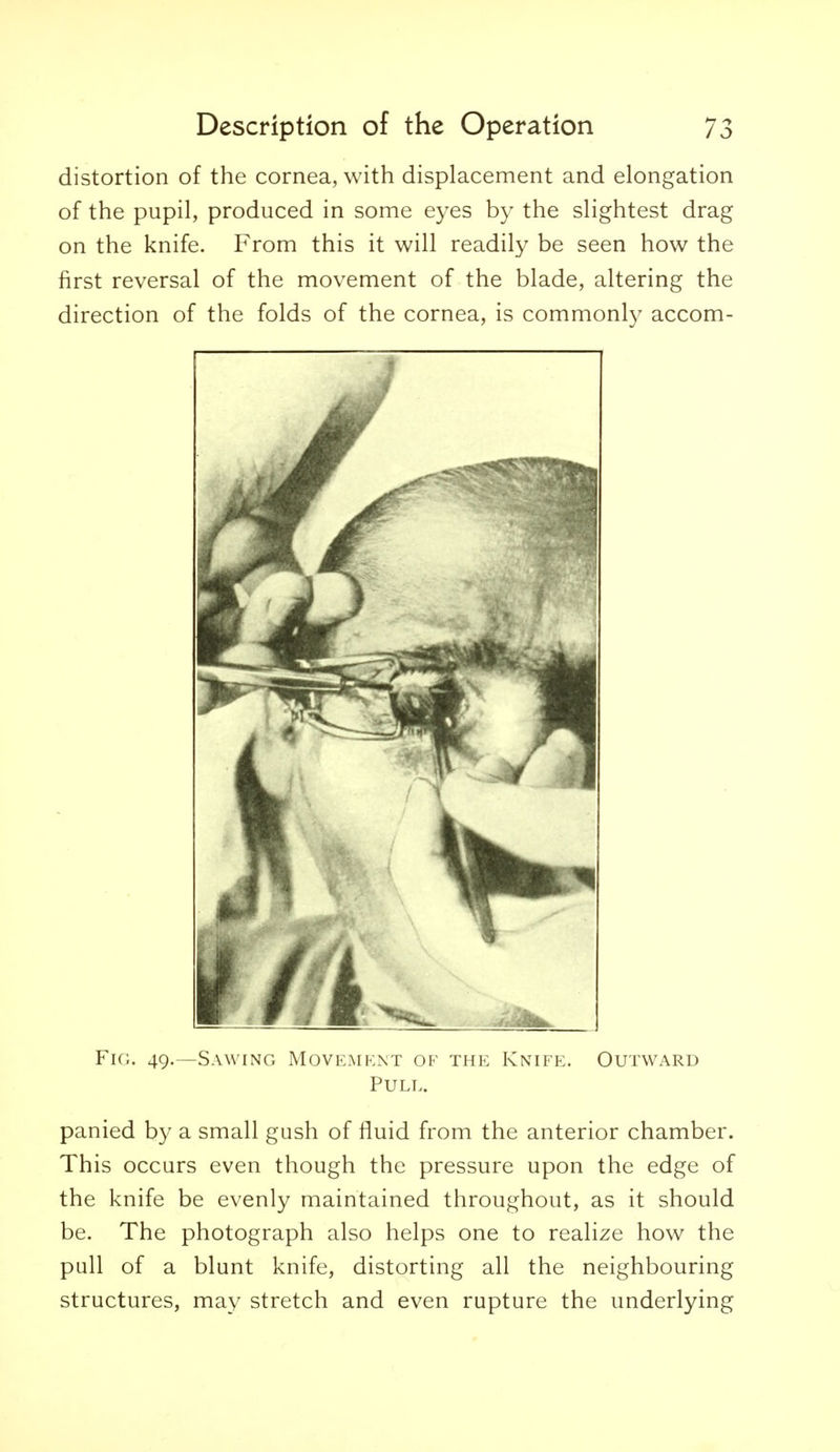 distortion of the cornea, with displacement and elongation of the pupil, produced in some eyes by the slightest drag on the knife. From this it will readily be seen how the first reversal of the movement of the blade, altering the direction of the folds of the cornea, is commonly accom- FiG. 49.—Sawing Movement of the Knife. Outward Pull. panied by a small gush of fluid from the anterior chamber. This occurs even though the pressure upon the edge of the knife be evenly maintained throughout, as it should be. The photograph also helps one to realize how the pull of a blunt knife, distorting all the neighbouring structures, may stretch and even rupture the underlying