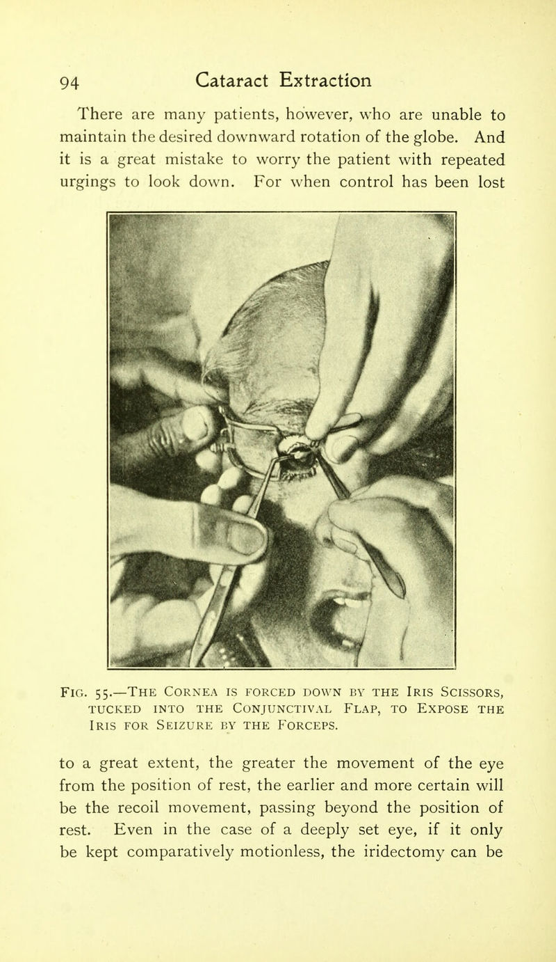 There are many patients, however, who are unable to maintain the desired downward rotation of the globe. And it is a great mistake to worry the patient with repeated urgings to look down. For when control has been lost Fig. 55.—The Cornea is forced down by the Iris Scissors, tucked into the conjunctival flap, to expose the Iris for Seizure by the Forceps. to a great extent, the greater the movement of the eye from the position of rest, the earlier and more certain will be the recoil movement, passing beyond the position of rest. Even in the case of a deeply set eye, if it only be kept comparatively motionless, the iridectomy can be