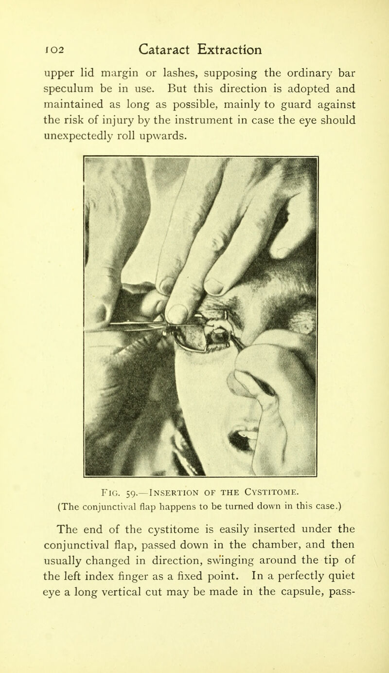 upper lid margin or lashes, supposing the ordinary bar speculum be in use. But this direction is adopted and maintained as long as possible, mainly to guard against the risk of injury by the instrument in case the eye should unexpectedly roll upwards. Fig. 59.—Insertion of the Cystitome. (The conjunctival flap happens to be turned down in this case.) The end of the cystitome is easily inserted under the conjunctival flap, passed down in the chamber, and then usually changed in direction, swinging around the tip of the left index finger as a fixed point. In a perfectly quiet eye a long vertical cut may be made in the capsule, pass-