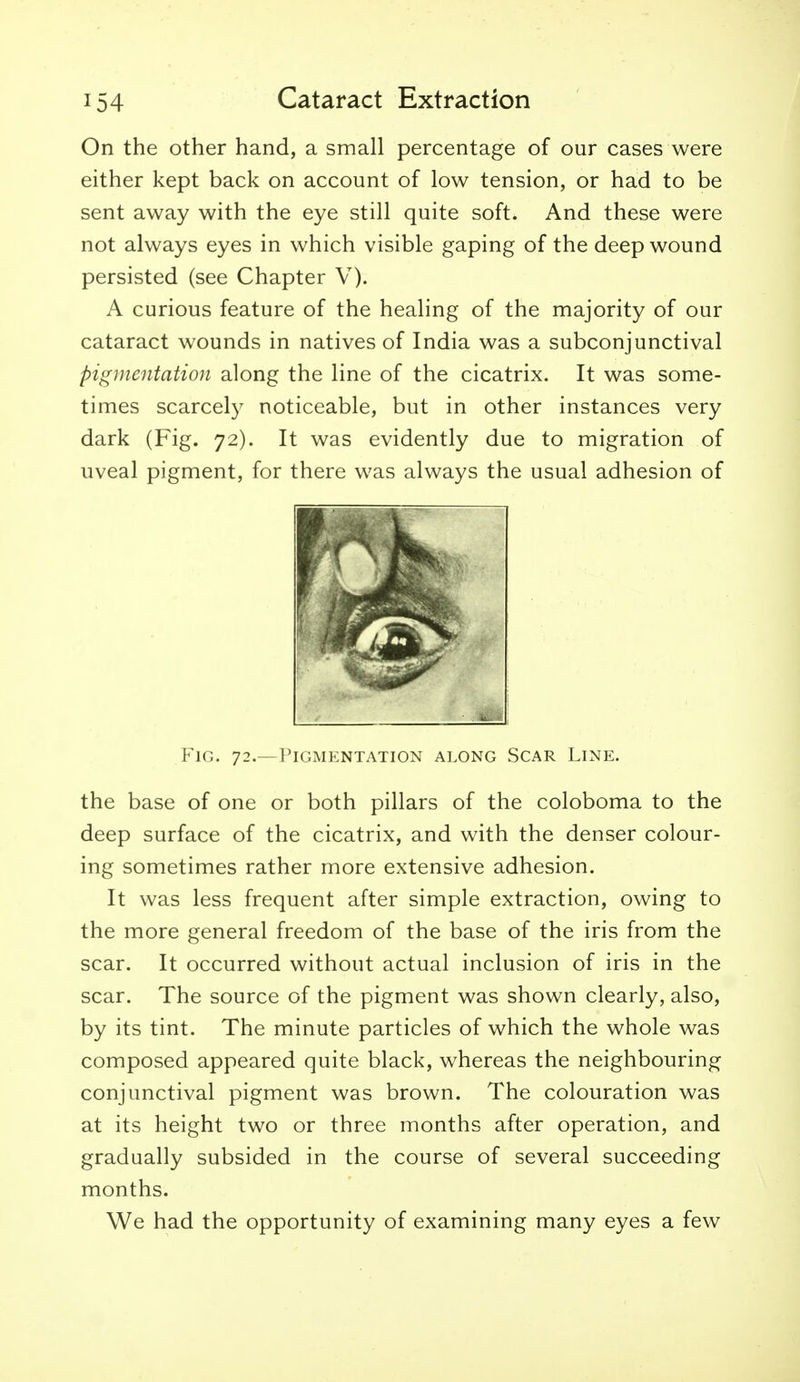 On the other hand, a small percentage of our cases were either kept back on account of low tension, or had to be sent away with the eye still quite soft. And these were not always eyes in which visible gaping of the deep wound persisted (see Chapter V). A curious feature of the healing of the majority of our cataract wounds in natives of India was a subconjunctival pigmentation along the line of the cicatrix. It was some- times scarcely noticeable, but in other instances very dark (Fig. 72). It was evidently due to migration of uveal pigment, for there was always the usual adhesion of Fig. 72.—Pigmentation along Scar Line. the base of one or both pillars of the coloboma to the deep surface of the cicatrix, and with the denser colour- ing sometimes rather more extensive adhesion. It was less frequent after simple extraction, owing to the more general freedom of the base of the iris from the scar. It occurred without actual inclusion of iris in the scar. The source of the pigment was shown clearly, also, by its tint. The minute particles of which the whole was composed appeared quite black, whereas the neighbouring conjunctival pigment was brown. The colouration was at its height two or three months after operation, and gradually subsided in the course of several succeeding months. We had the opportunity of examining many eyes a few