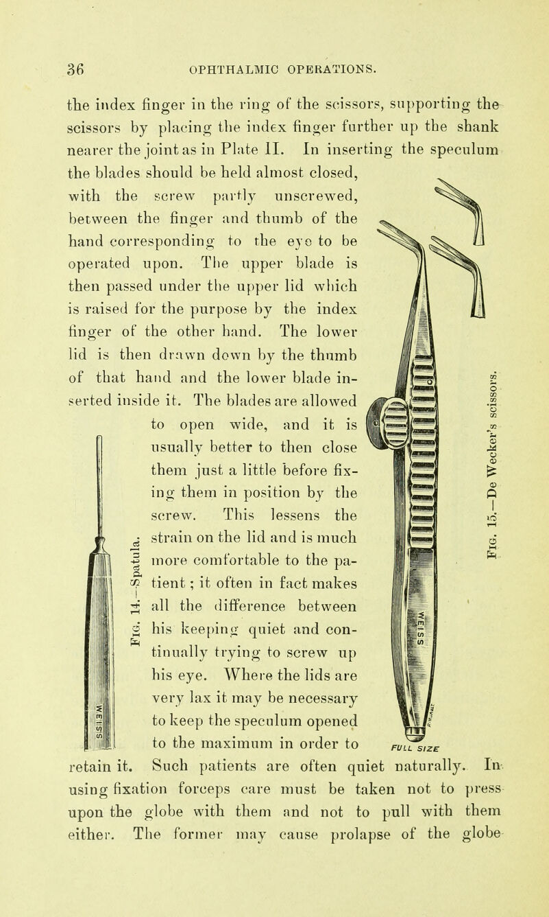the index finger in the ring of the scissors, supporting the^ scissors by placing tlie index finger further up the shank nearer the joint as in Plate II. In inserting the speculum the blades should be held almost closed, with the screw partly unscrewed, between the finger and thumb of the hand corresponding to the eye to be operated upon. Tlie upper blade is then passed under the upper lid which is raised for the purpose by the index finger of the other hand. The lower lid is then drawn down by the thumb of that hand and the lower blade in- serted inside it. The blades are allowed to open wide, and it is usually better to then close them just a little before fix- ing them in position hy the screw. This lessens the ^ strain on the lid and is much I more comfortable to the pa- Pi ^ tient; it often in fact makes ;2i all the difference between g his keeping quiet and con- tinually trying to screw up his eye. Where the lids are Blil v^i'.y i^^y be necessary to keep the speculum opened to the maximum in order to retain it. Such patients are often quiet naturally. In using fixation forceps care must be taken not to press upon the globe with them and not to pull with them either. The former may cause prolapse of the globe