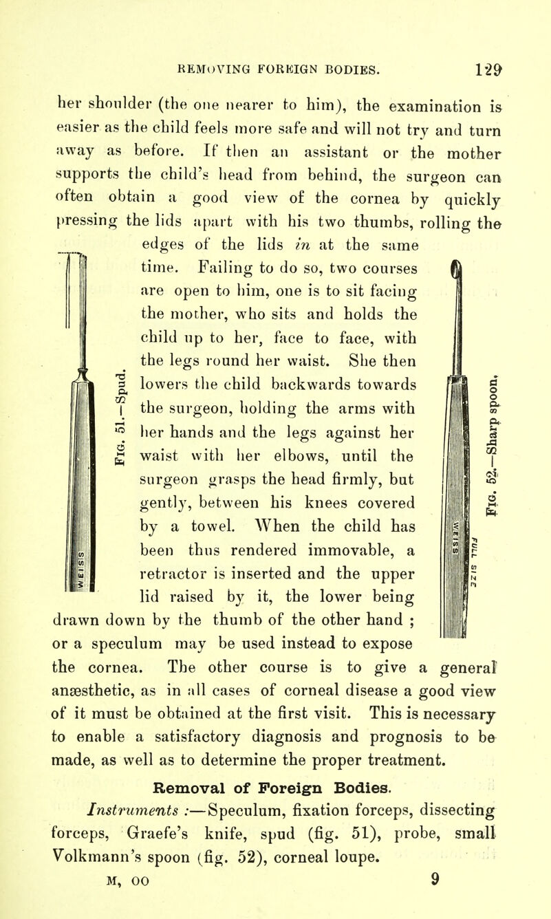 REMOVING FOREIGN BODIES. her shoulder (the one nearer to him), the examination i& easier as the child feels more safe and will not try and turn away as before. If tlien an assistant or the mother supports tbe child's head from behind, the surgeon can often obtain a good view of the cornea by quickly pressing the lids apart with his two thumbs, rolling the edges of the lids in at the same time. Failing to do so, two courses are open to him, one is to sit facing the mother, who sits and holds the child up to her, face to face, with the legs round her waist. She then 1 lowers the child backwards towards I the surgeon, holding the arms with her hands and the legs against her g waist with lier elbows, until the surgeon grasps the head firmly, but gently, between his knees covered by a towel. When the child has been thus rendered immovable, a retractor is inserted and the upper lid raised by it, the lower being drawn down by the thumb of the other hand ; or a speculum may be used instead to expose the cornea. The other course is to give a general anaesthetic, as in all cases of corneal disease a good view of it must be obtained at the first visit. This is necessary to enable a satisfactory diagnosis and prognosis to be made, as well as to determine the proper treatment. Removal of Foreign Bodies. Instruments :—Speculum, fixation forceps, dissecting forceps, Graefe's knife, spud (fig. 51), probe, small Volkmann's spoon (fig. 52), corneal loupe. M, 00 9 CO